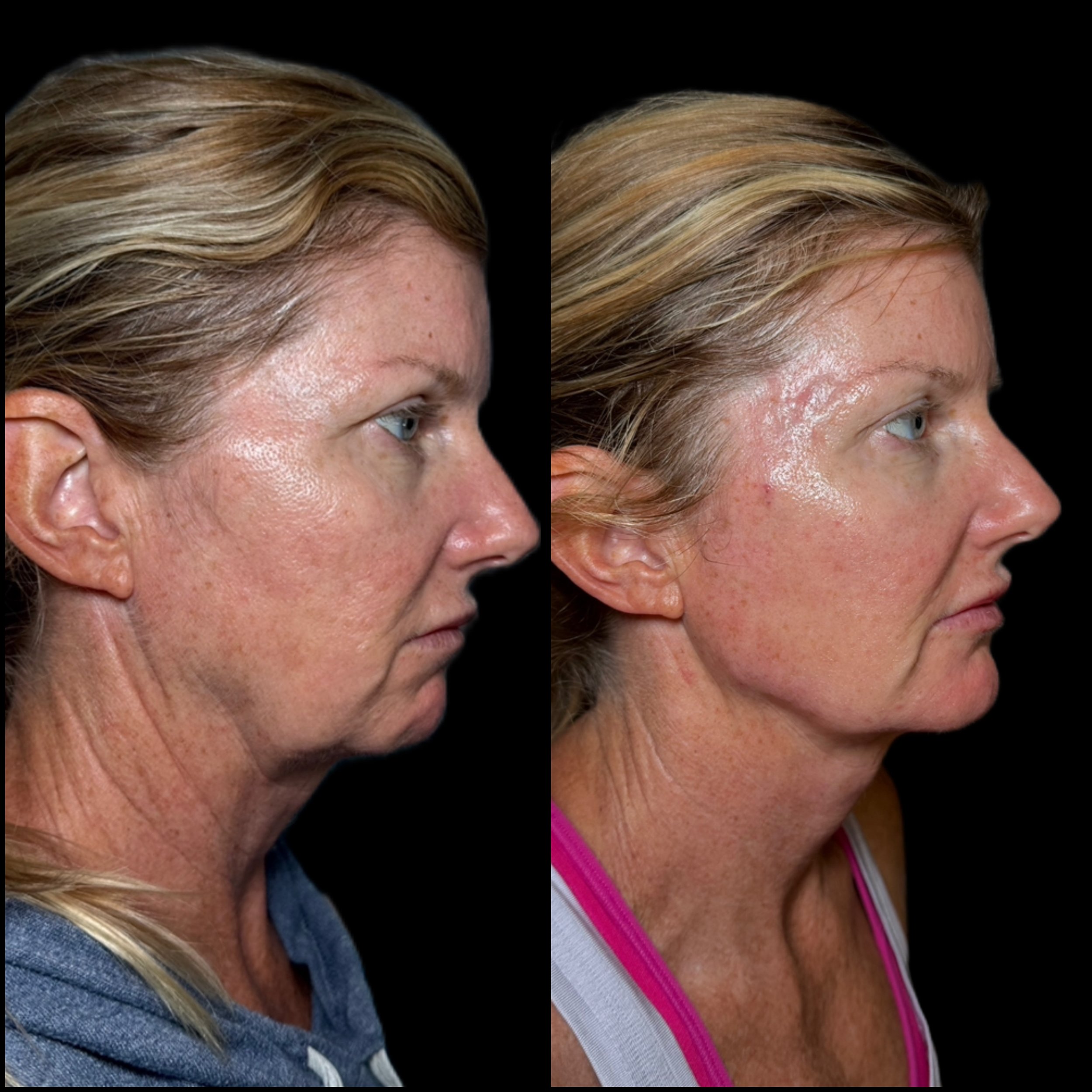 Side-by-side comparison of a woman's face before and after skincare treatment showing reduced wrinkles, redness, and improved skin texture.