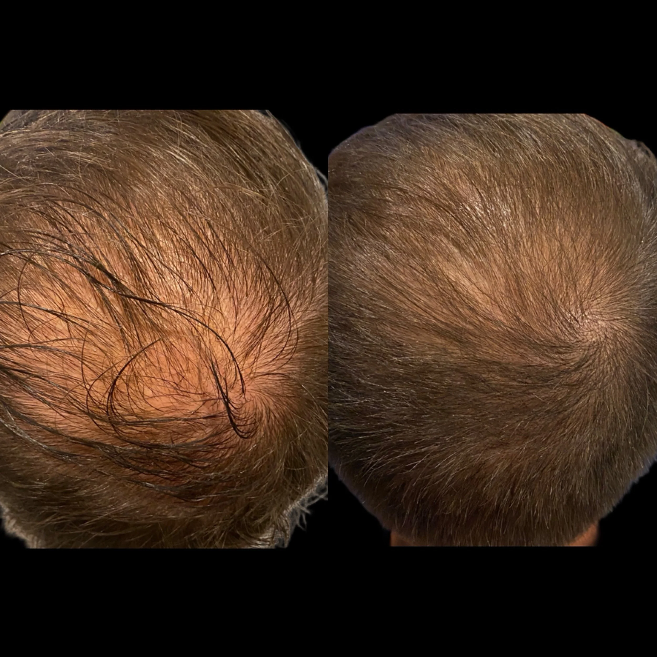 Comparison of the top of a person's head showing hair loss before and after hair restoration treatment.