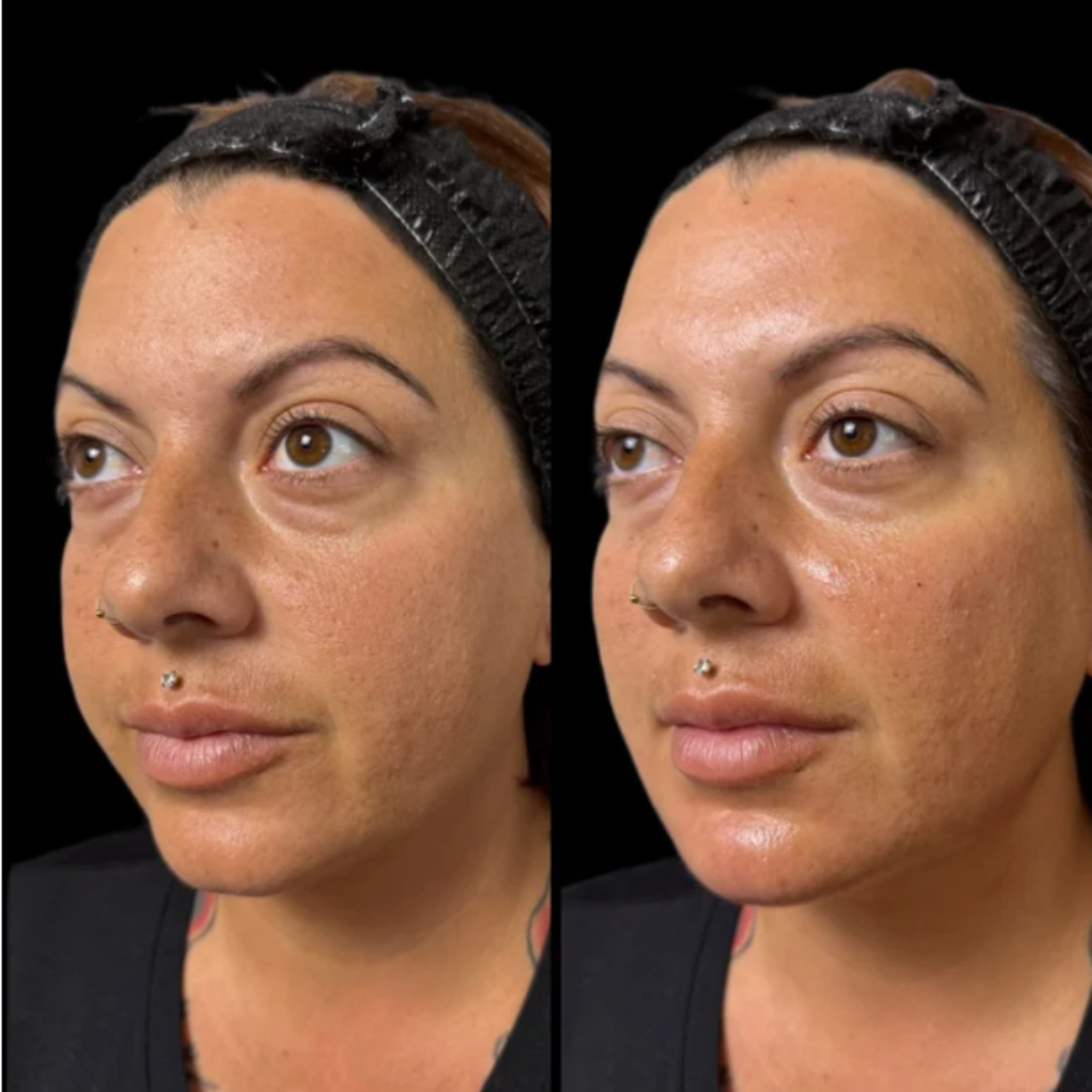 Side-by-side comparison of a woman's face before and after facial treatment showing reduction in skin redness and improvement in skin texture.