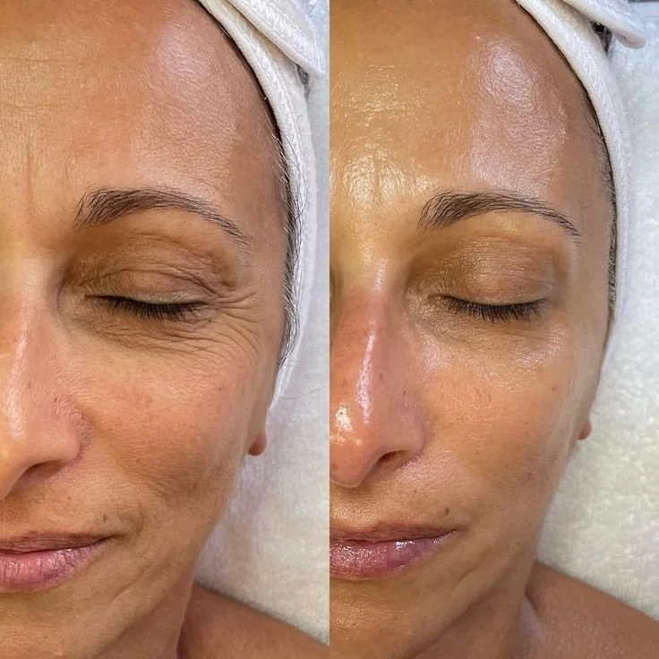 Close-up of a woman's face before and after skincare treatment, showing improved skin texture and appearance.