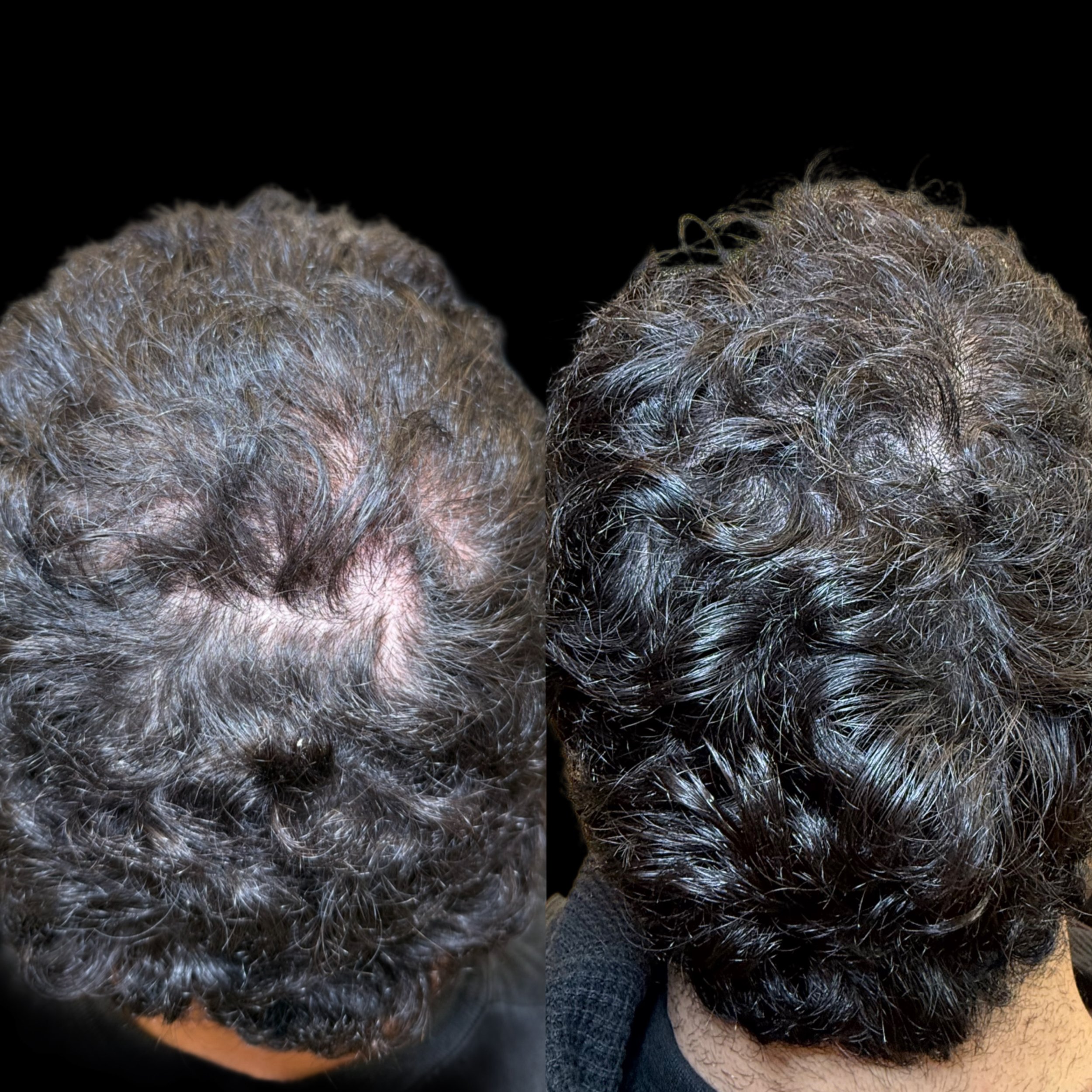 Comparison of the top view of a person's scalp before and after hair treatment showing significant improvement in hair density and coverage.