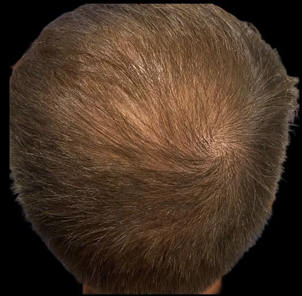 Top view of a person's head with short light brown hair, showing thinning at the crown.