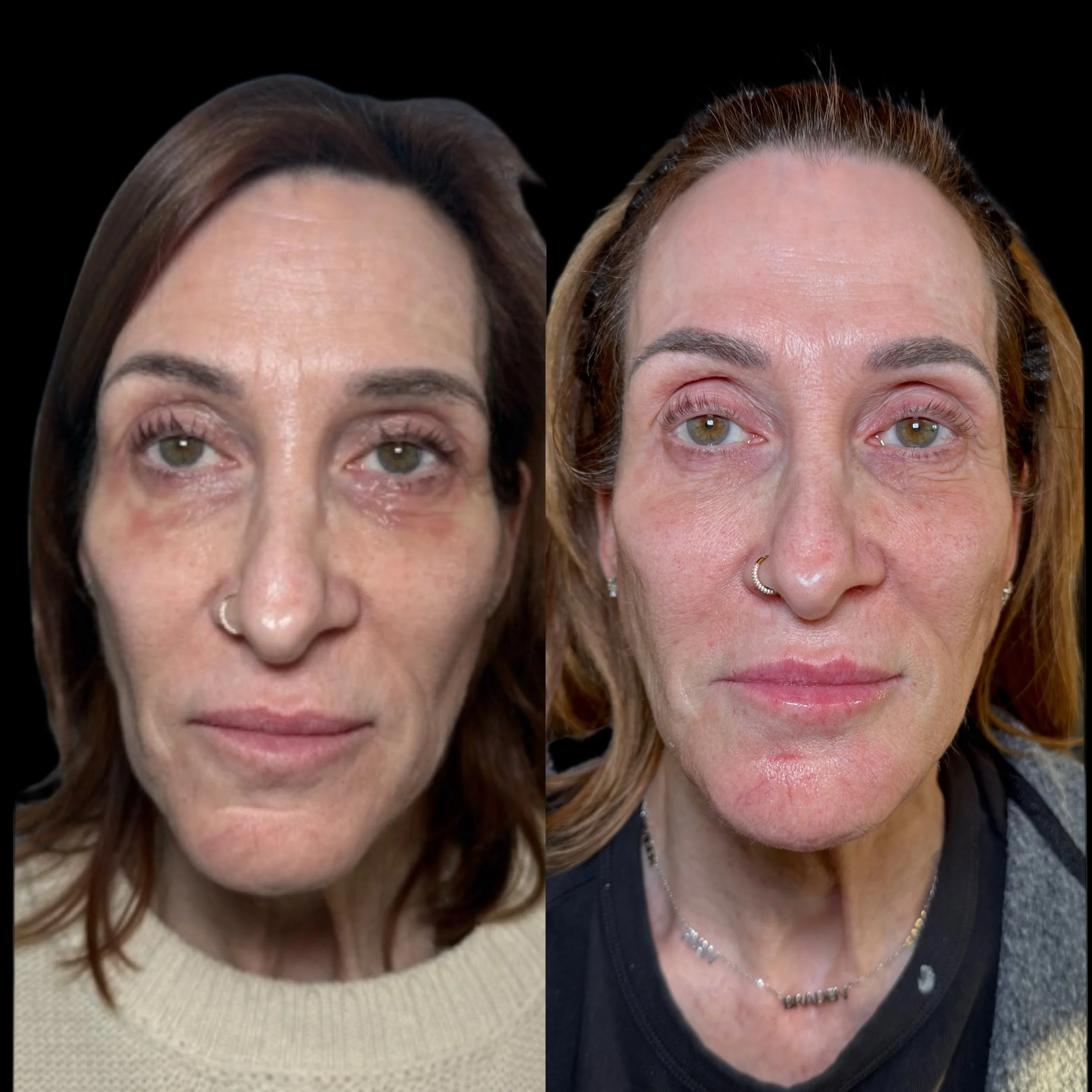 Side-by-side comparison of a woman's face before and after skincare or makeup, showcasing improvements in skin texture and appearance.