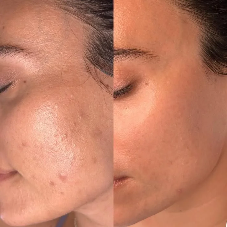 Side by side comparison of a woman's face before and after skincare; the left side shows oily skin with acne and blemishes, the right side shows clearer and smoother skin.