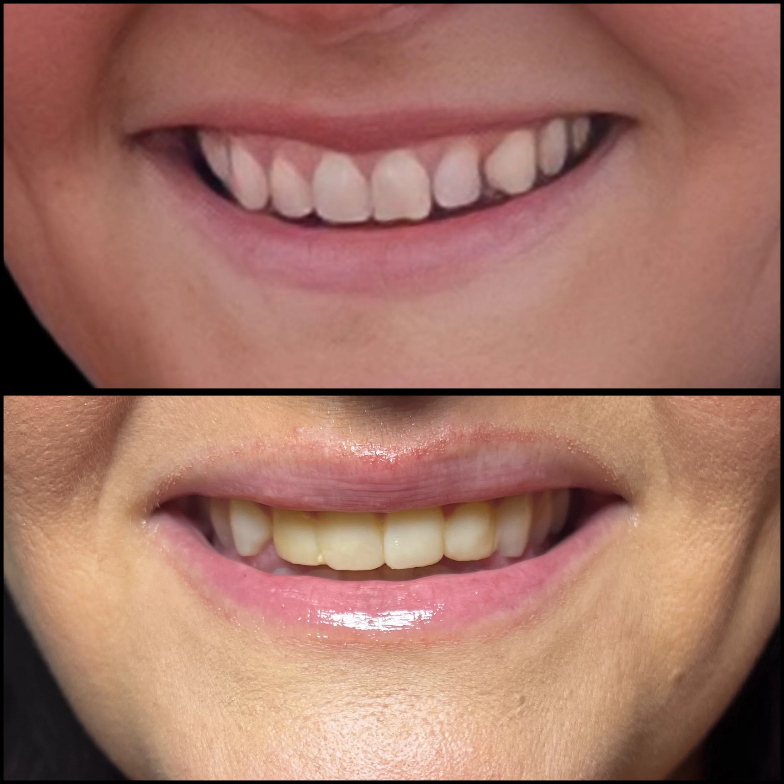 Close-up images of two smiling mouths, showing teeth with differences in alignment and color.