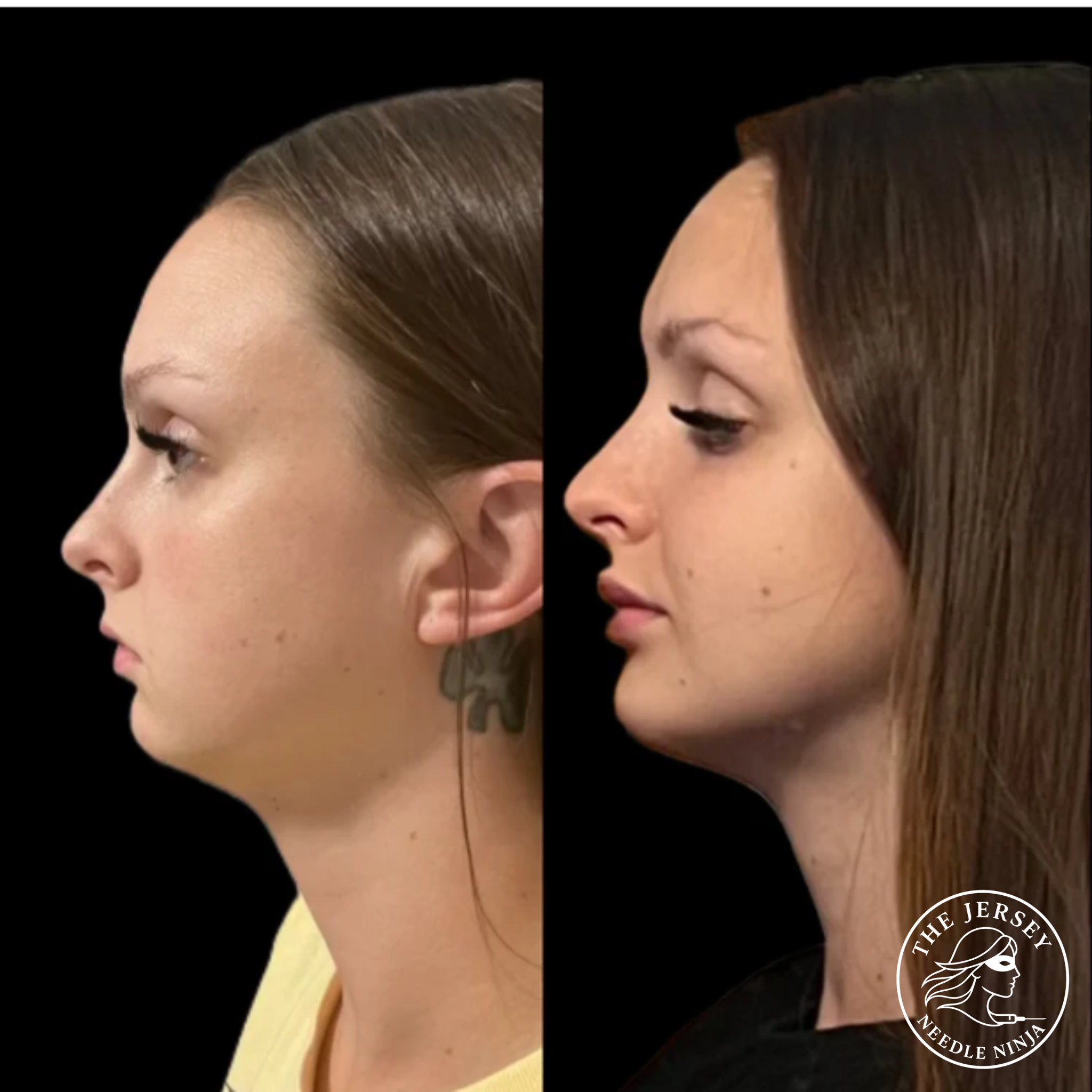 Side profile of a woman before and after cosmetic surgery, showing a thinner nose and more defined jawline in the after image.