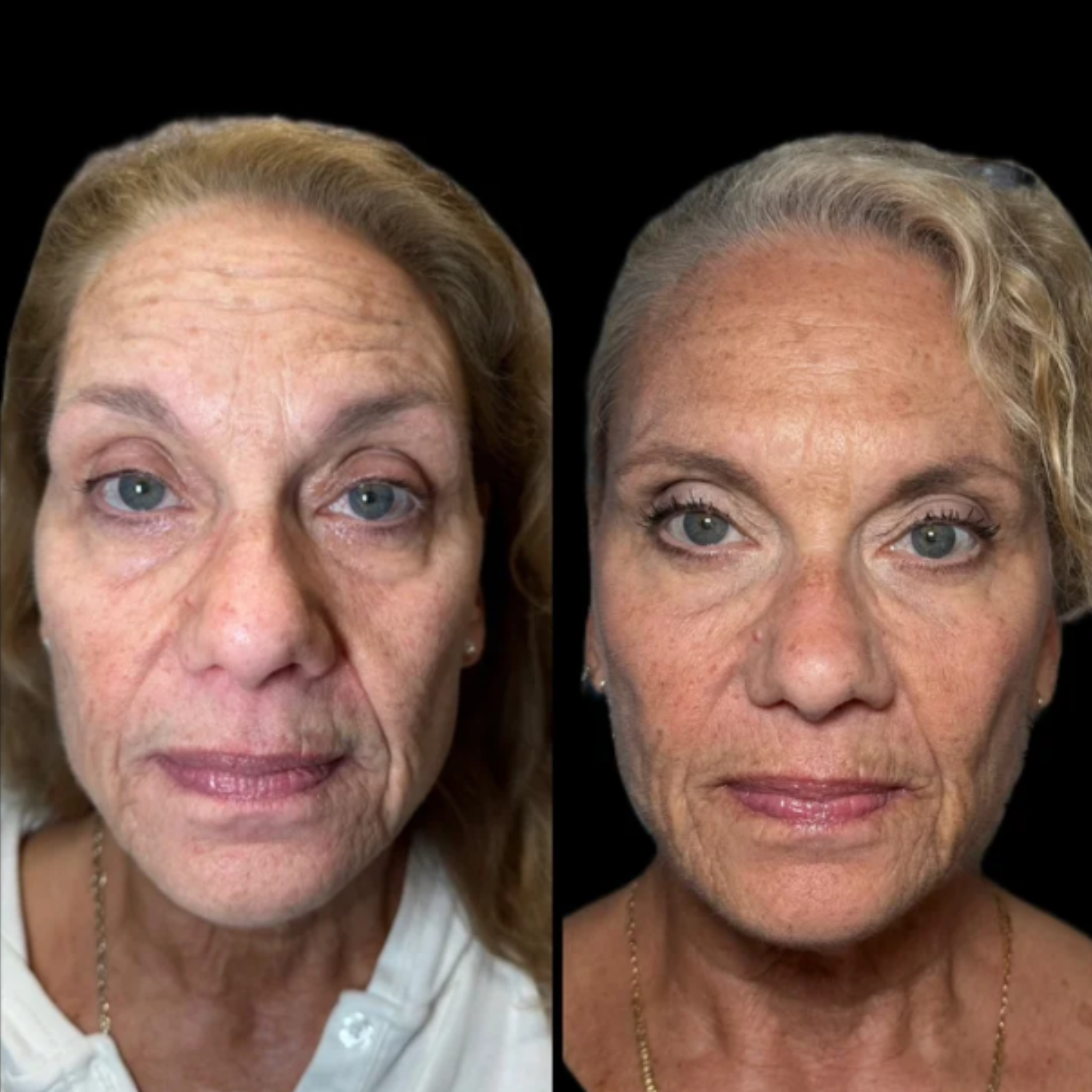 Side-by-side comparison of an elderly woman before and after skincare or cosmetic procedures, with improved skin texture and appearance on the right.