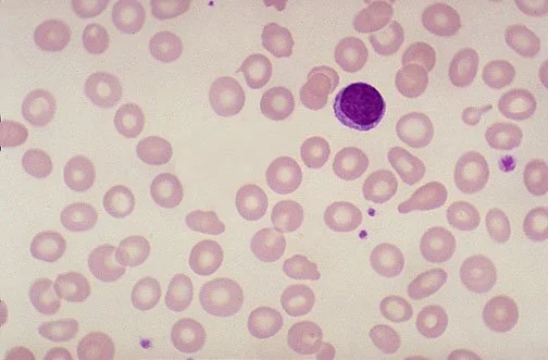 Microscopic view of blood cells showing red blood cells and a purple-stained white blood cell.