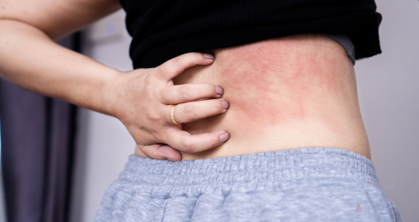 Person with red, irritated skin on side, holding their lower back in discomfort.