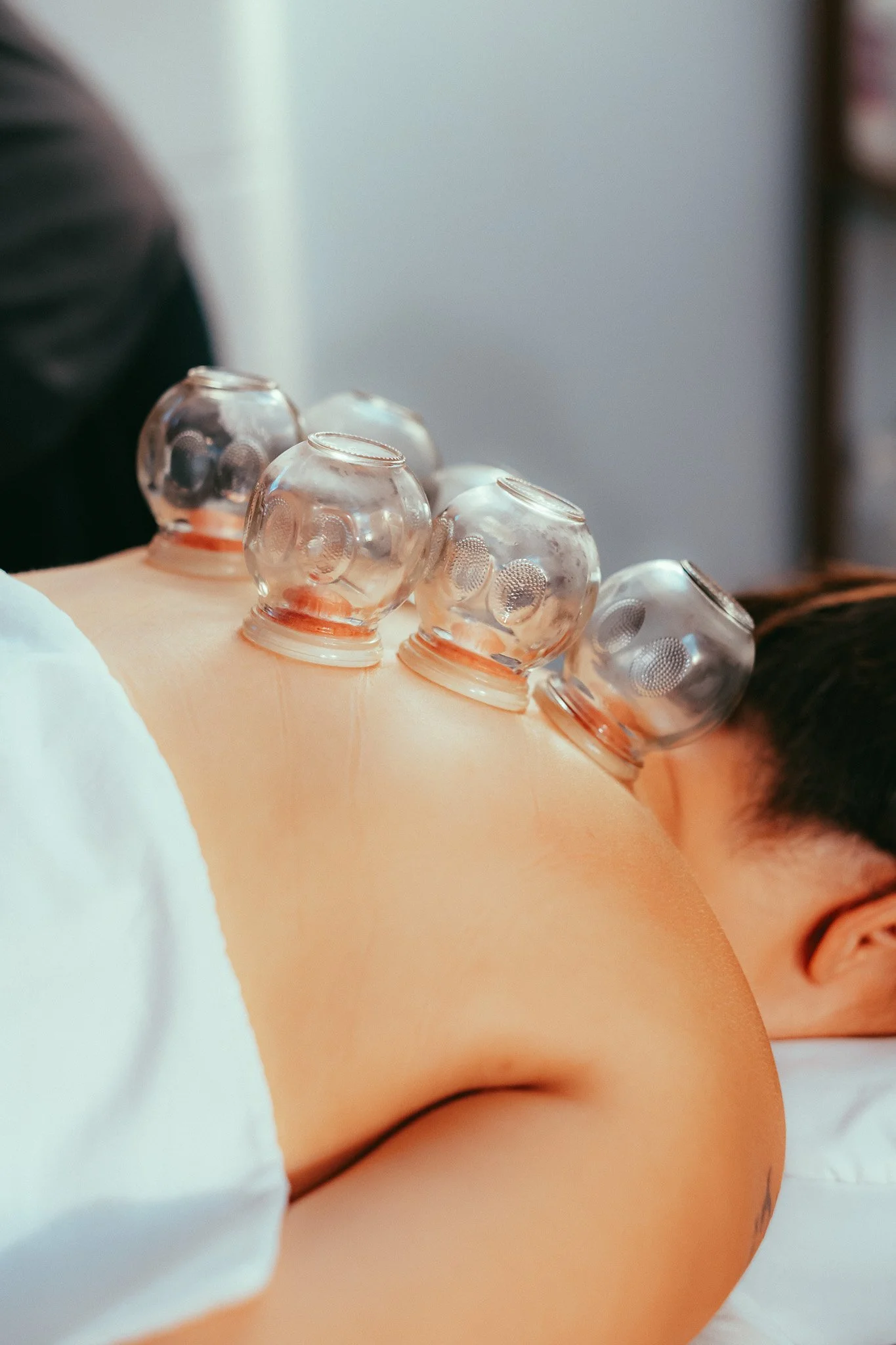 A close up image of 6 cups suctioned onto someone's back while they lay face down. You can see red skin inside the suction.