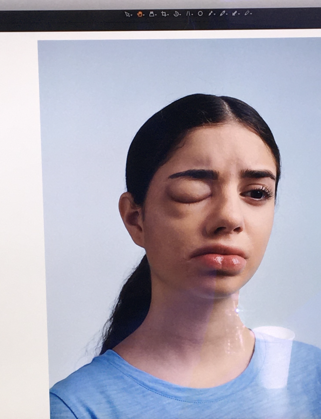 Hereditary Angioedema Awareness Prosthetic Makeup Photo