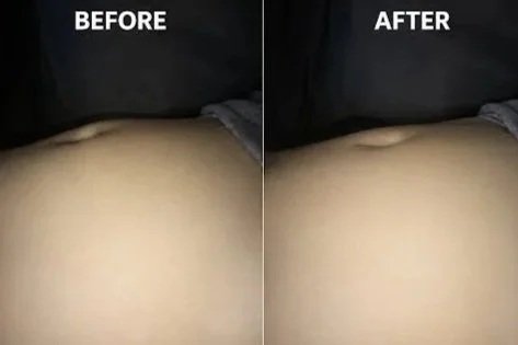 Abdomen contouring before and after lymph drainage massage at Nymphaea Therapeutics