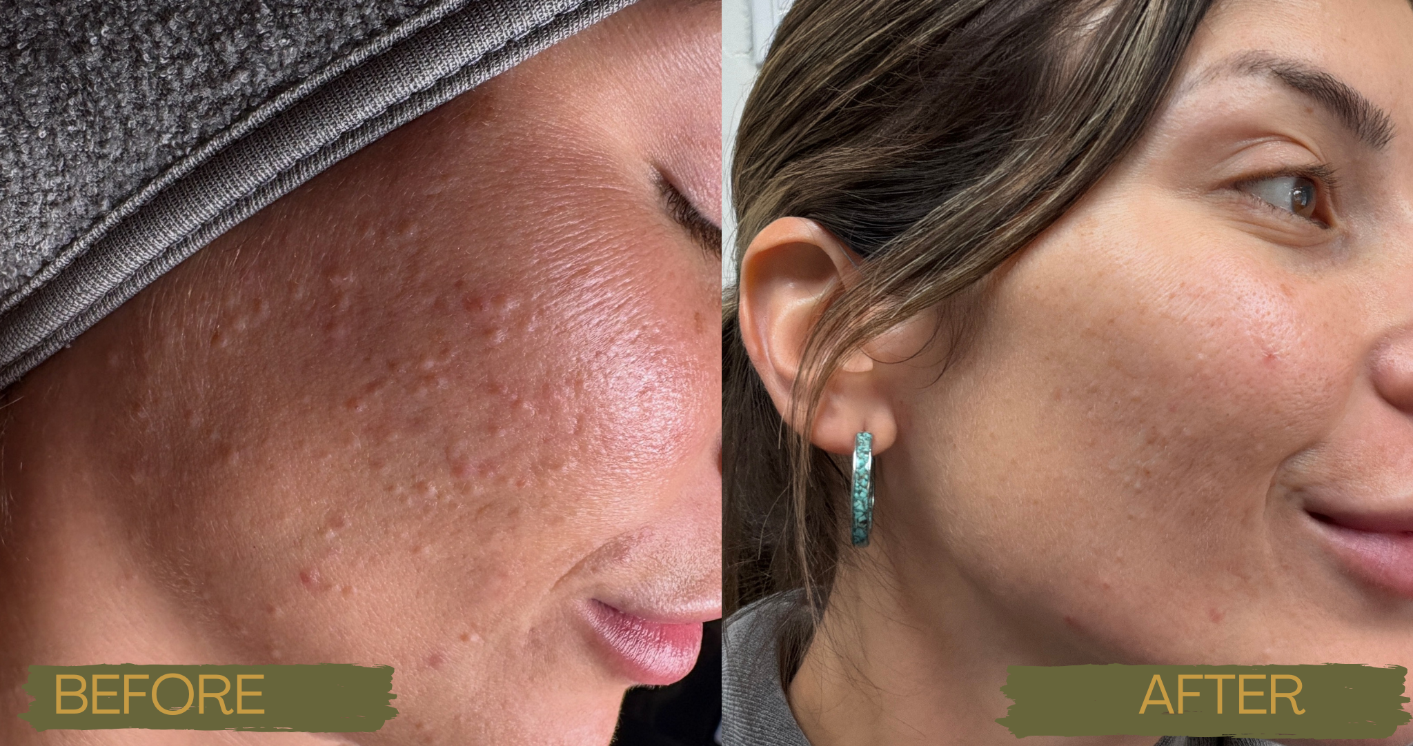 Close-up of a person's face showing skin with acne scars and blemishes on the left side labeled 'BEFORE'. The right side shows the same person's face with clear, smooth skin labeled 'AFTER'.
