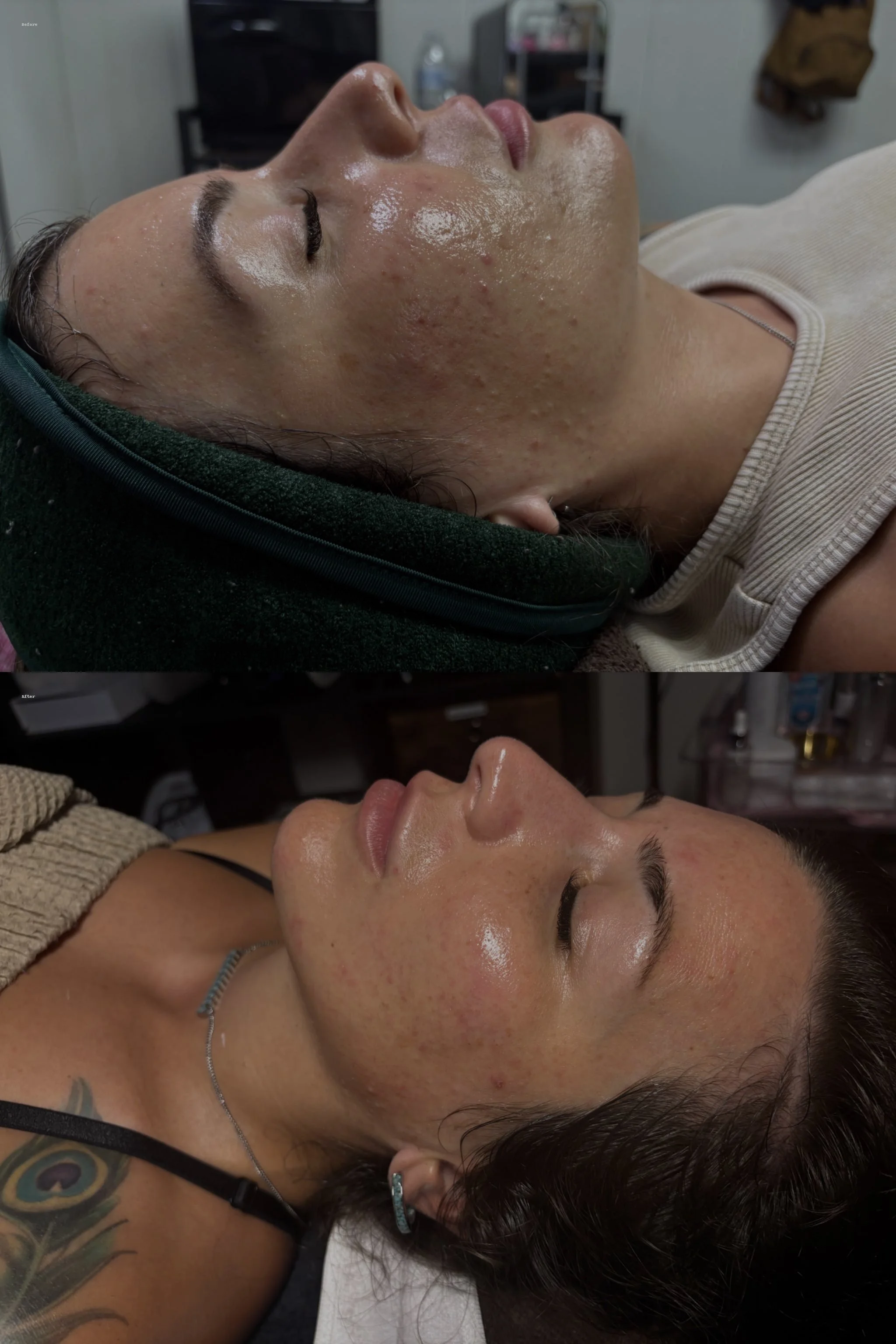 Side views of two women lying down, both with shiny, glowing skin and signs of acne or skin irritation.