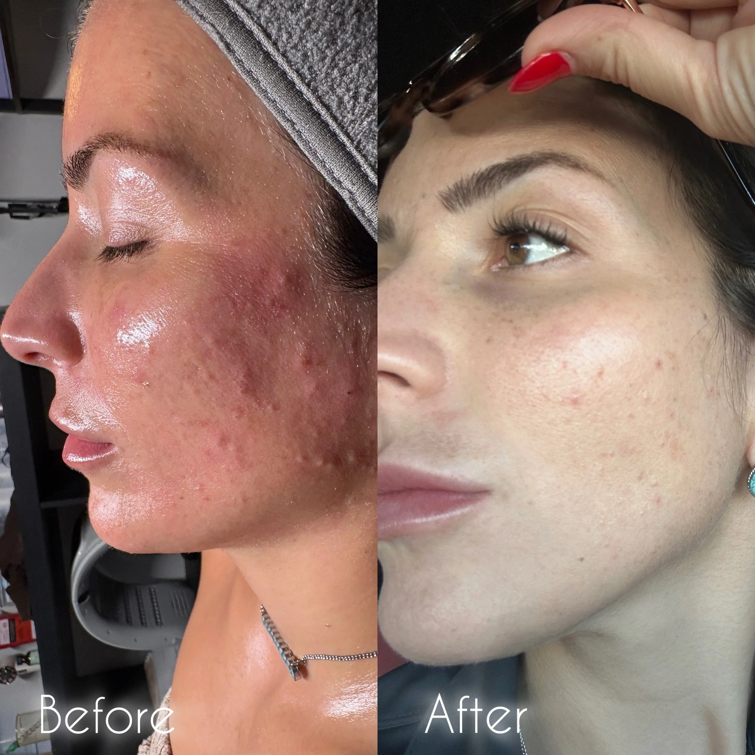Side-by-side comparison of a woman's face labeled 'Before' and 'After' showing improved skin condition, with the 'Before' side featuring redness, acne scars, and uneven texture, and the 'After' side showing clearer, smoother skin with fewer blemishes.