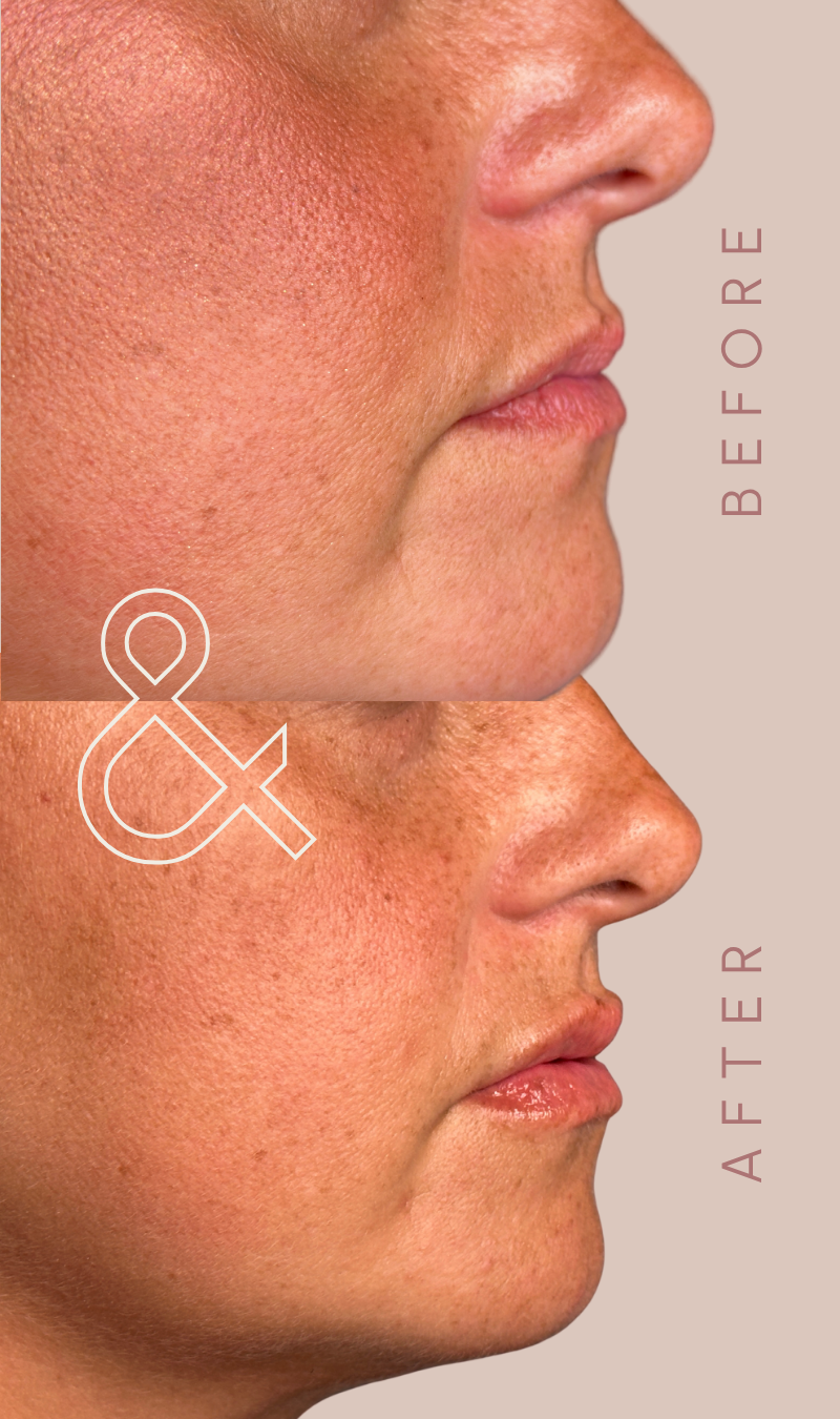Before and after side profile of a woman’s lips, showing softly plumped, hydrated lips with natural results at Willow Skin Therapy in Cincinnati.