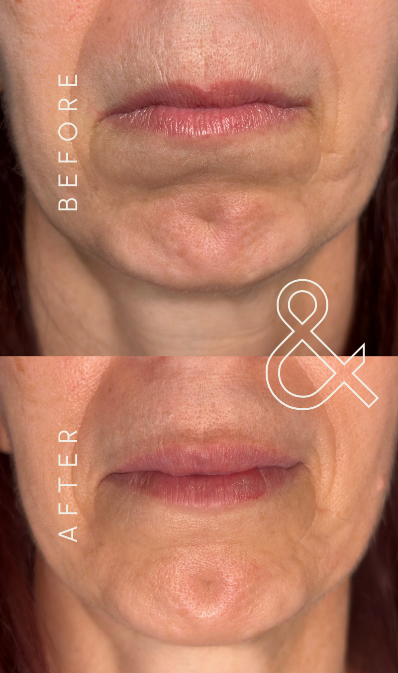 Before and after close-up of a woman’s mouth and chin, showing gently plumped lips and softened lines around the mouth at Willow Skin Therapy in Cincinnati.