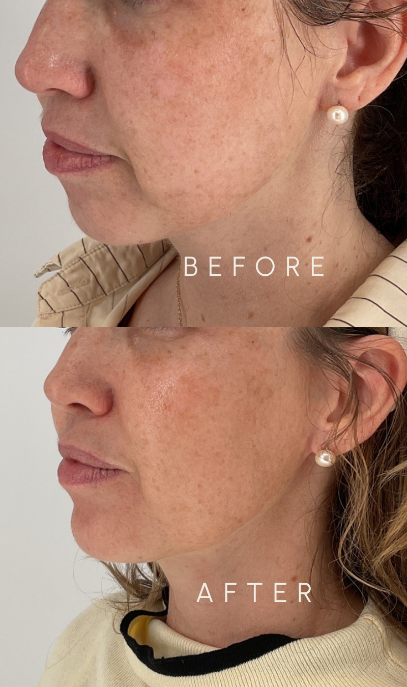 Before and after side view of a woman’s face, showing restored cheek contour, a smoother jawline, and a more refreshed look at Willow Skin Therapy in Cincinnati.