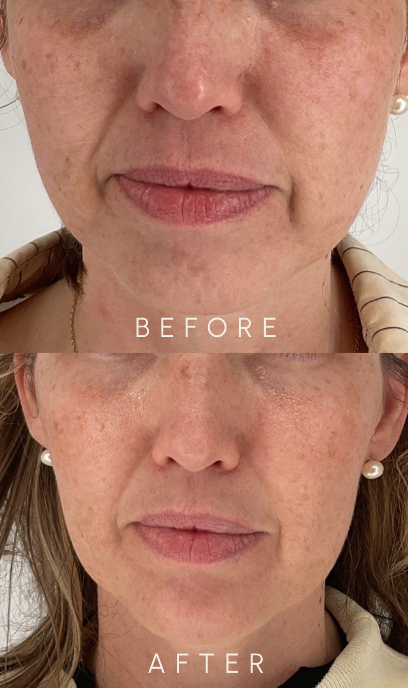 Before and after front view of a woman’s lower face, showing softened smile lines and gently restored cheek volume for a more rested look at Willow Skin Therapy in Cincinnati.