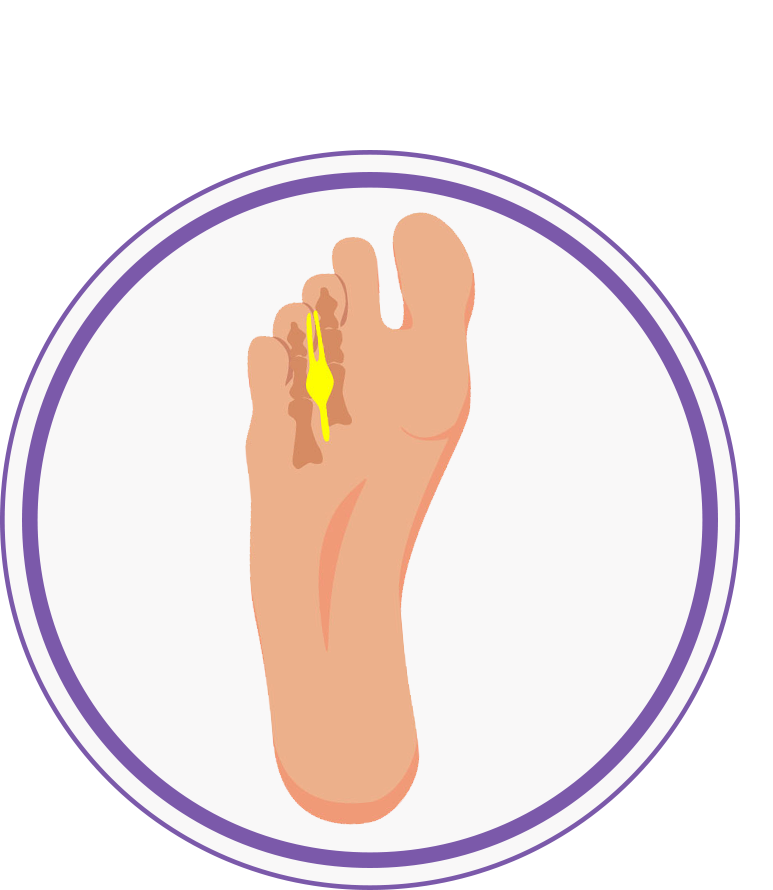 Morton's Neuroma