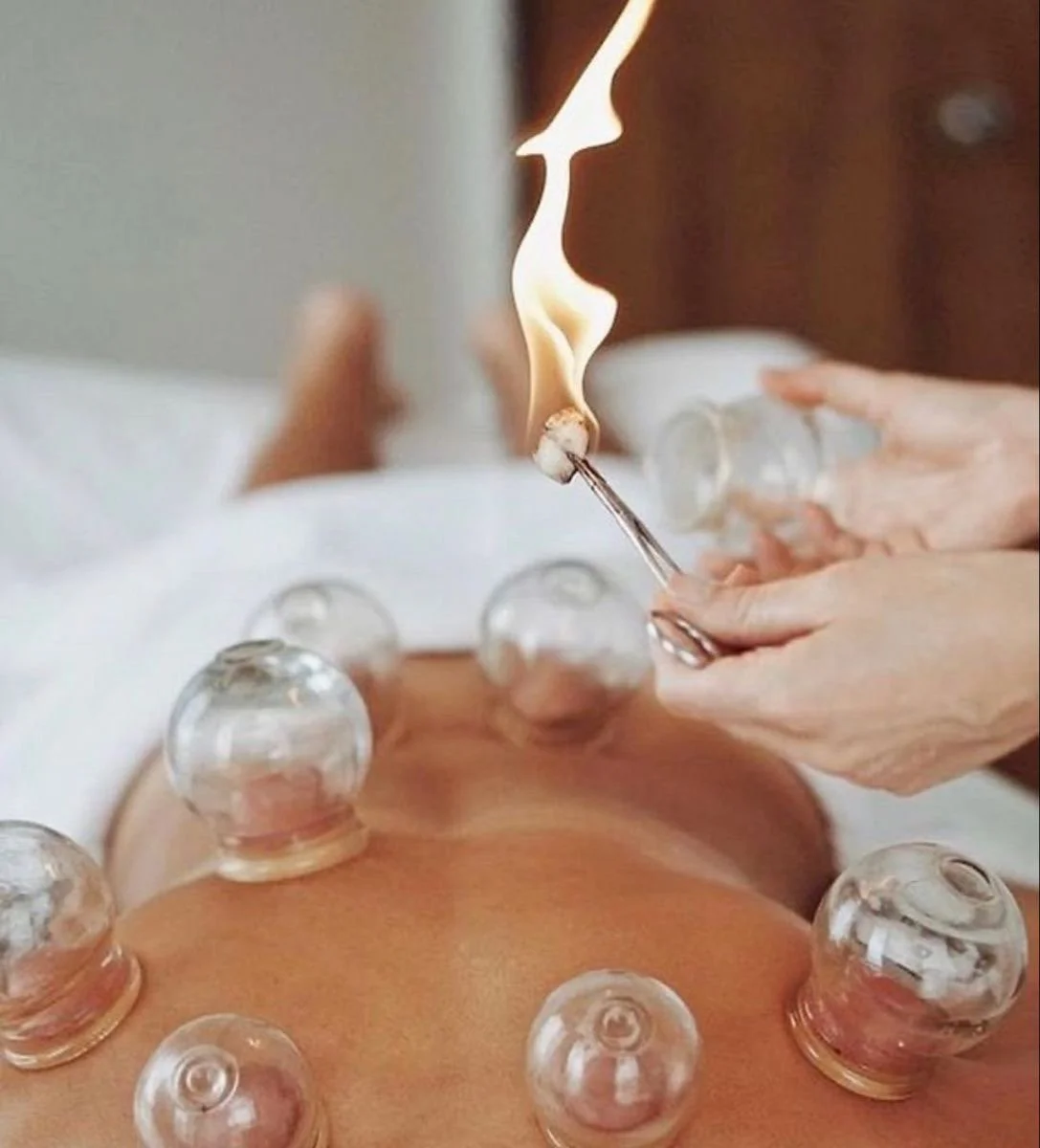 Person receiving cupping therapy with small glass cups on their back as they hold a lit match to create vacuum.