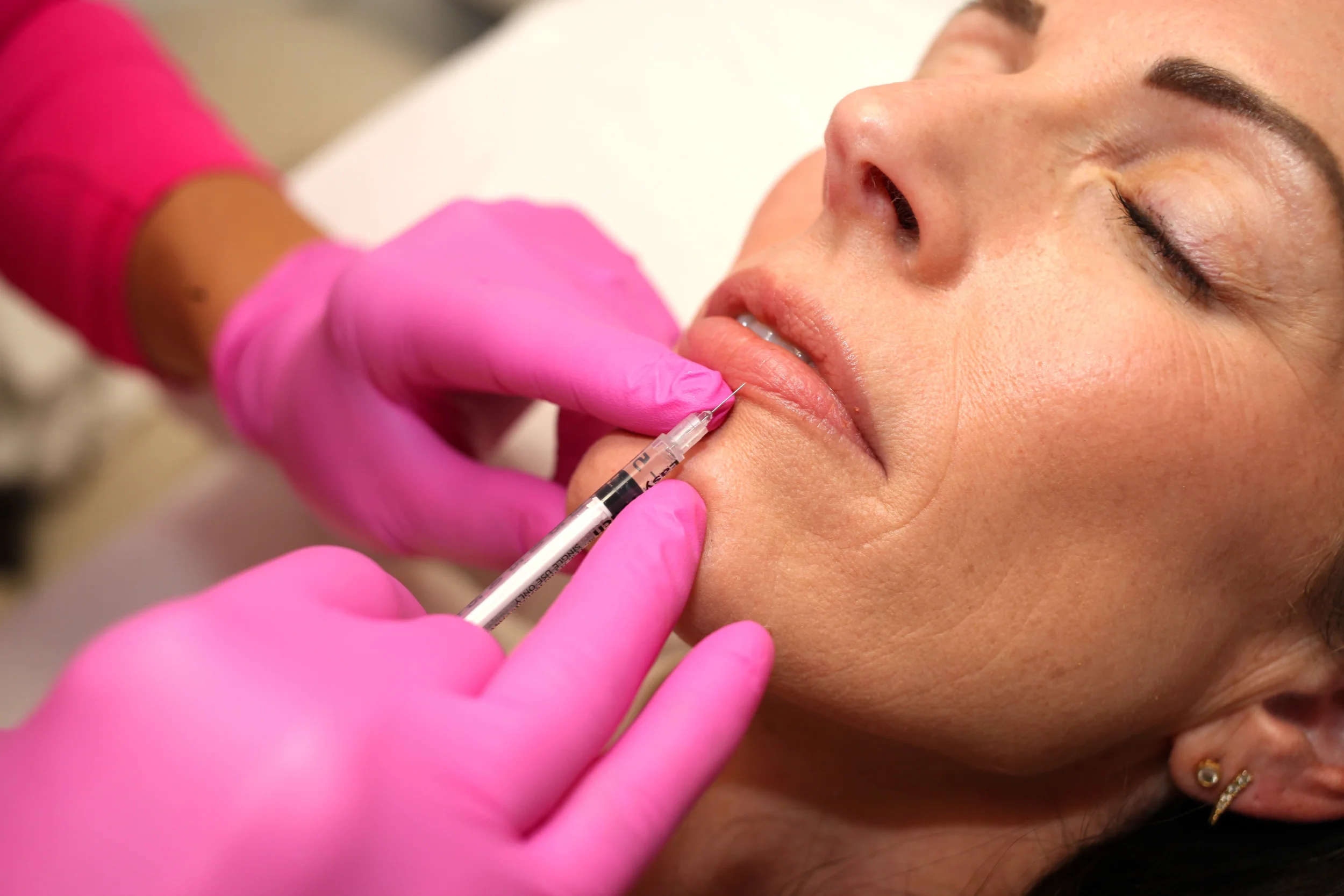 Close-up of a woman receiving a cosmetic injection in her lips with a syringe, wearing pink gloves.