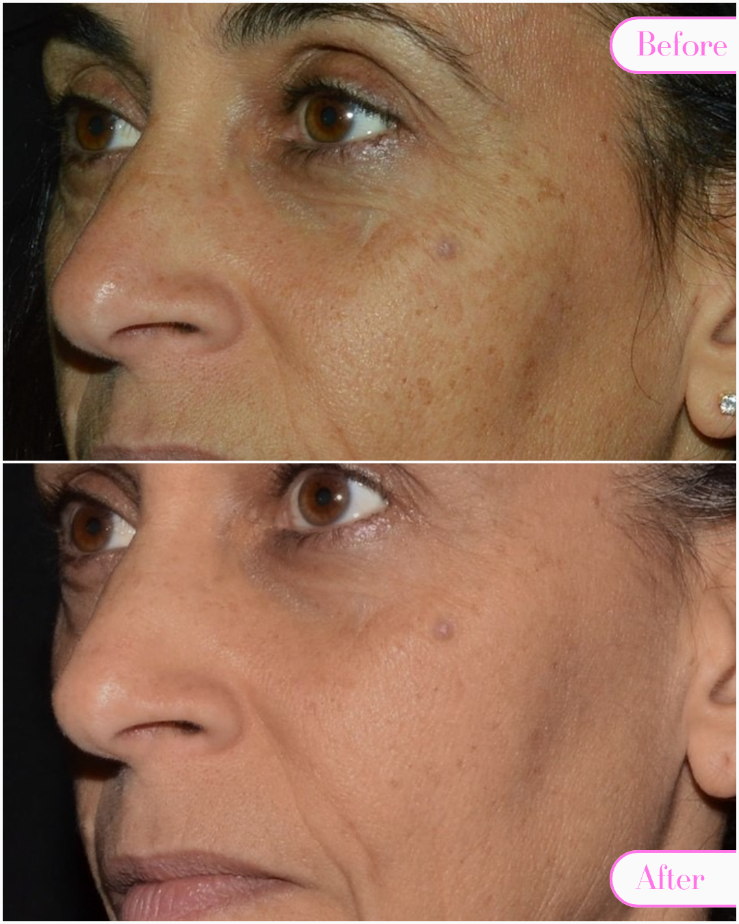 HollaceMD - Before + Afters - Ultra Pigment -1.png