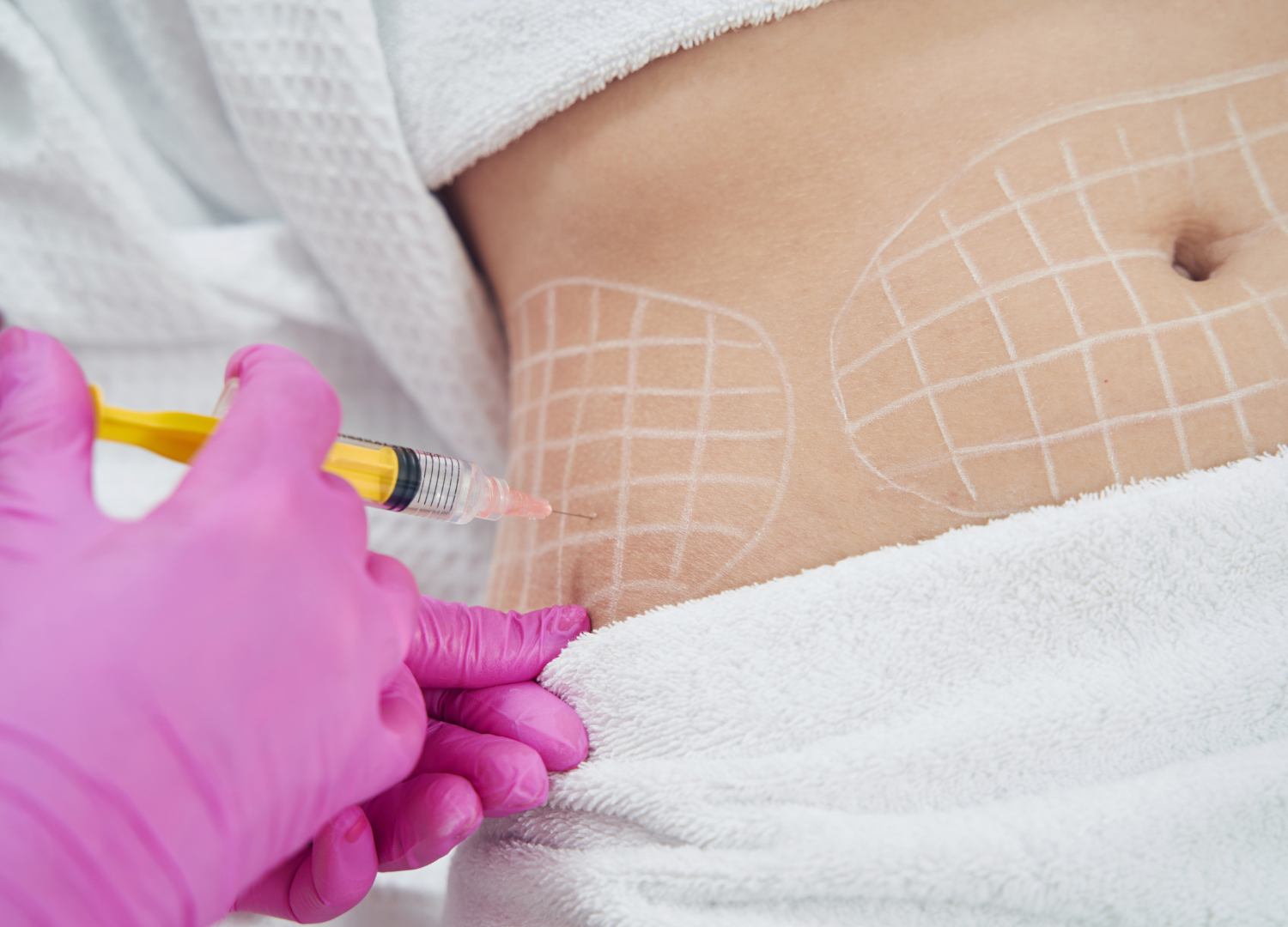 Deoxycholic Acid Injections "The Fat Blaster"