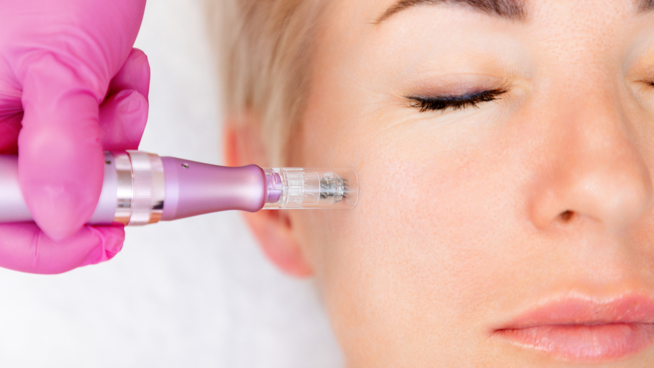 Start your microneedling and chemical peel treatments now for a flawless look during the holidays