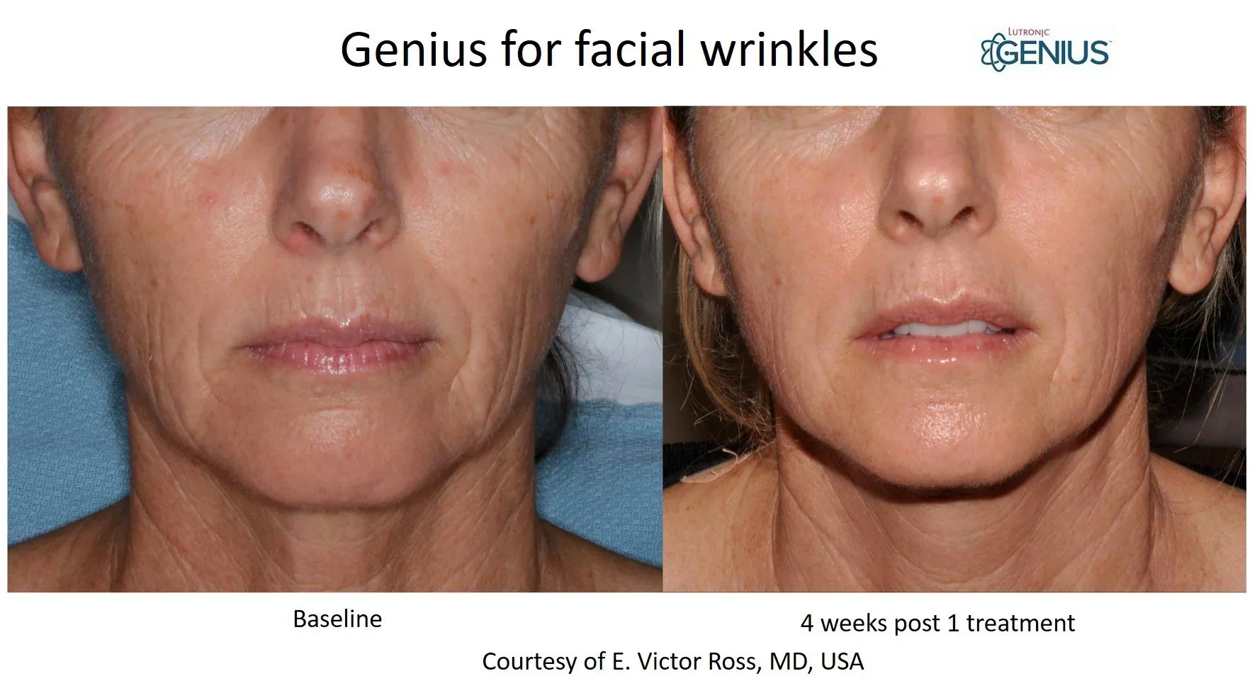 Genius RF Microneedling: A Smarter Way to Rejuvenate Your Skin