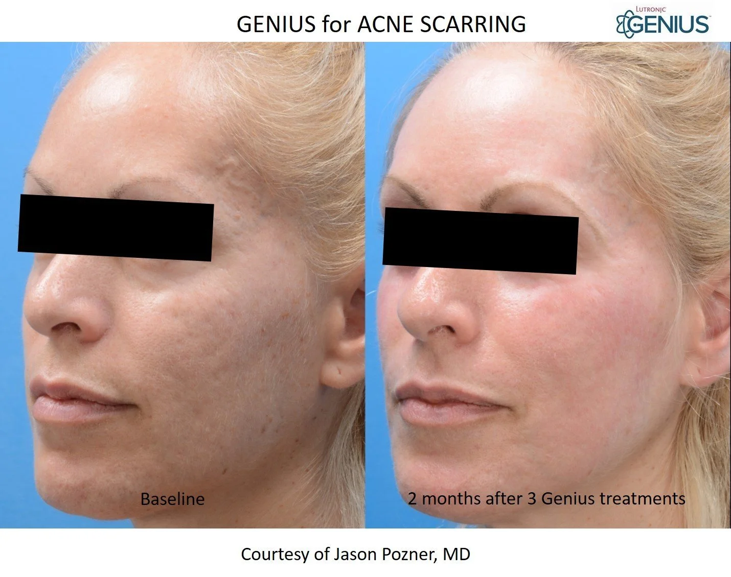 Genius+Pozner+Acne+Scars.webp