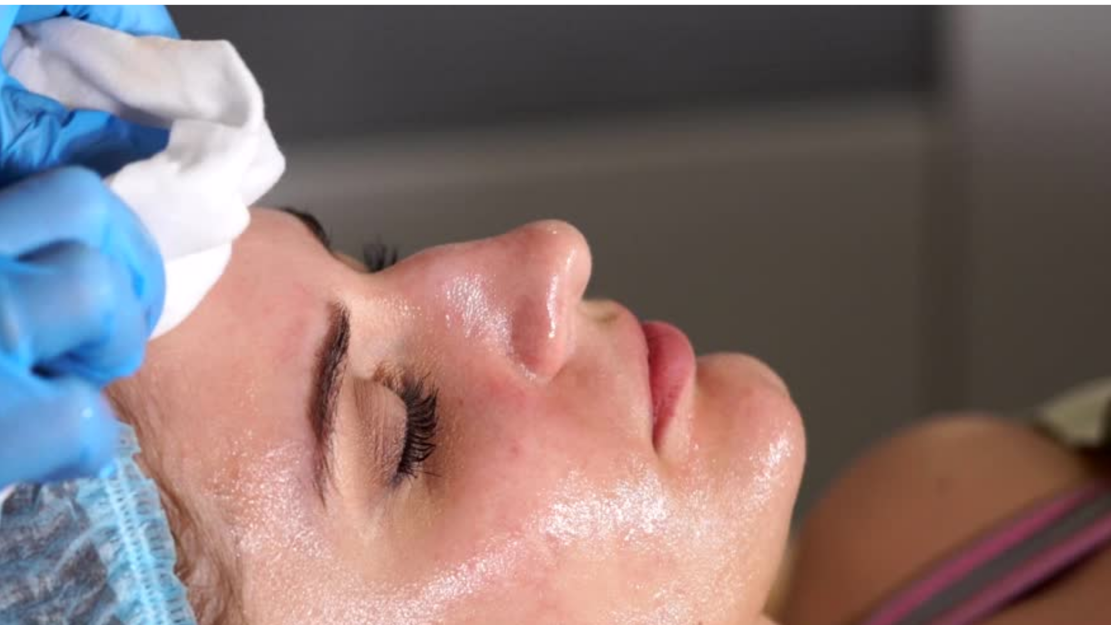 Not All Peels Are the Same: The Science Behind VI Chemical Peels