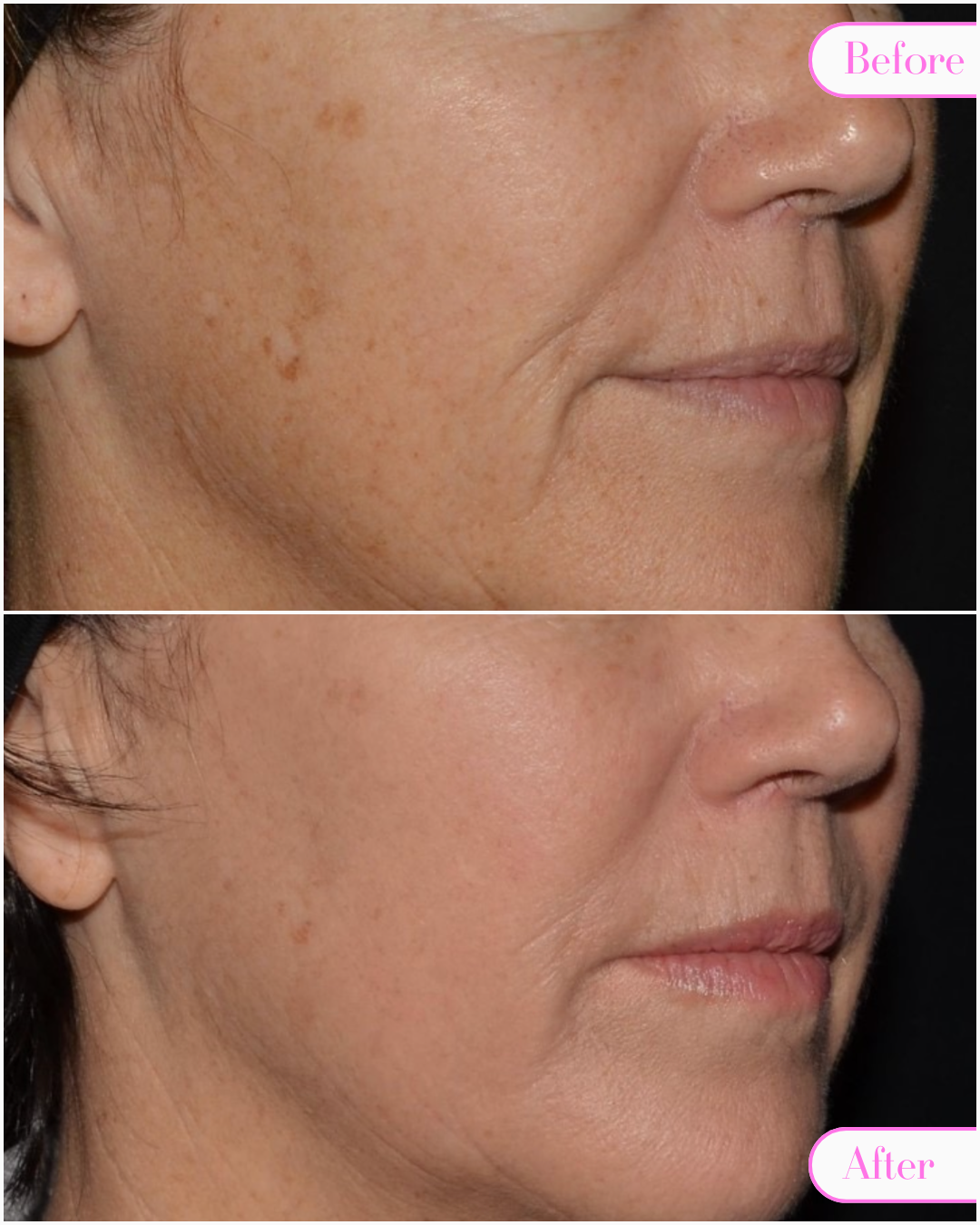 HollaceMD - Before + Afters - Ultra Pigment - 4.png