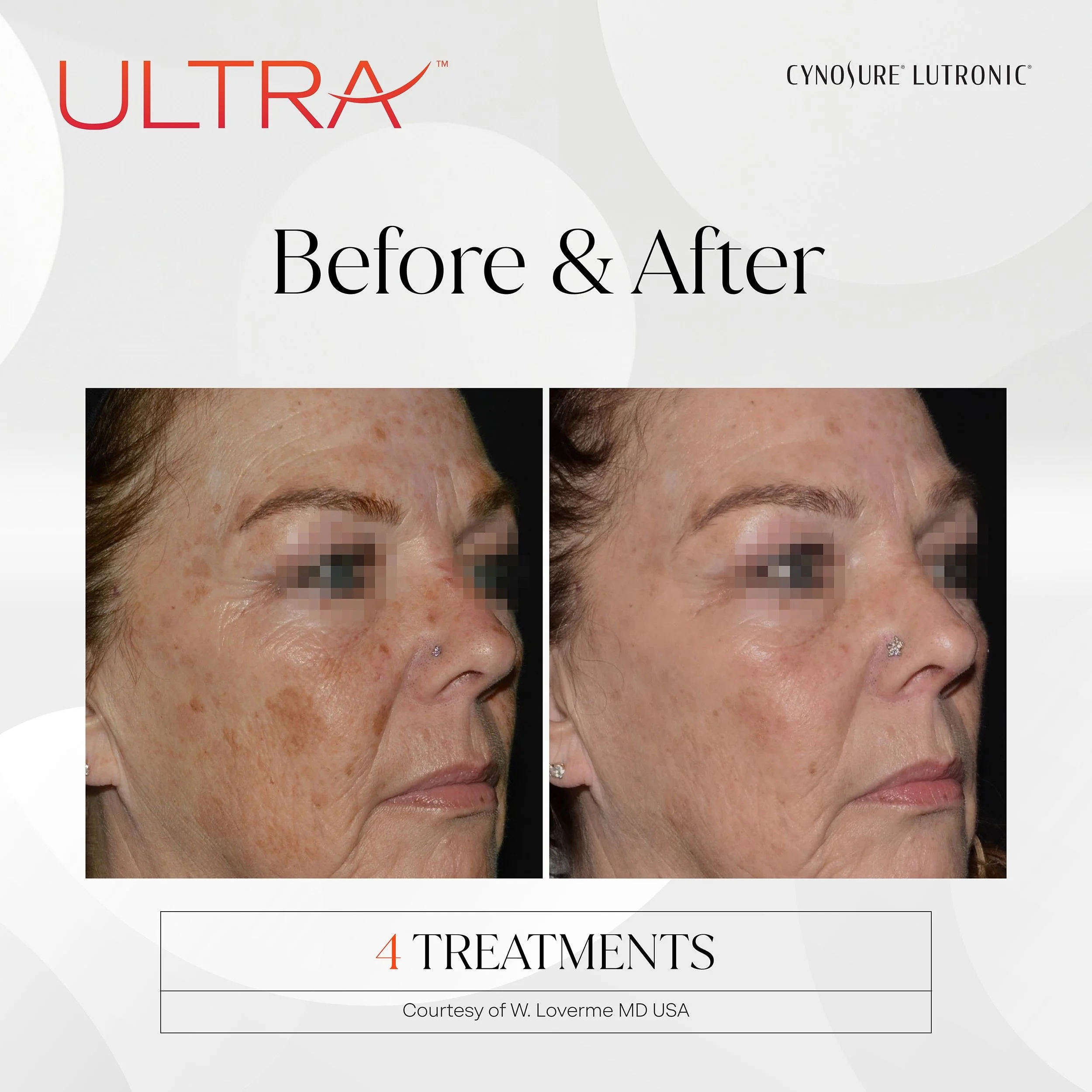 Ultra Pigment: A Smarter Approach to Brighter, More Even Skin