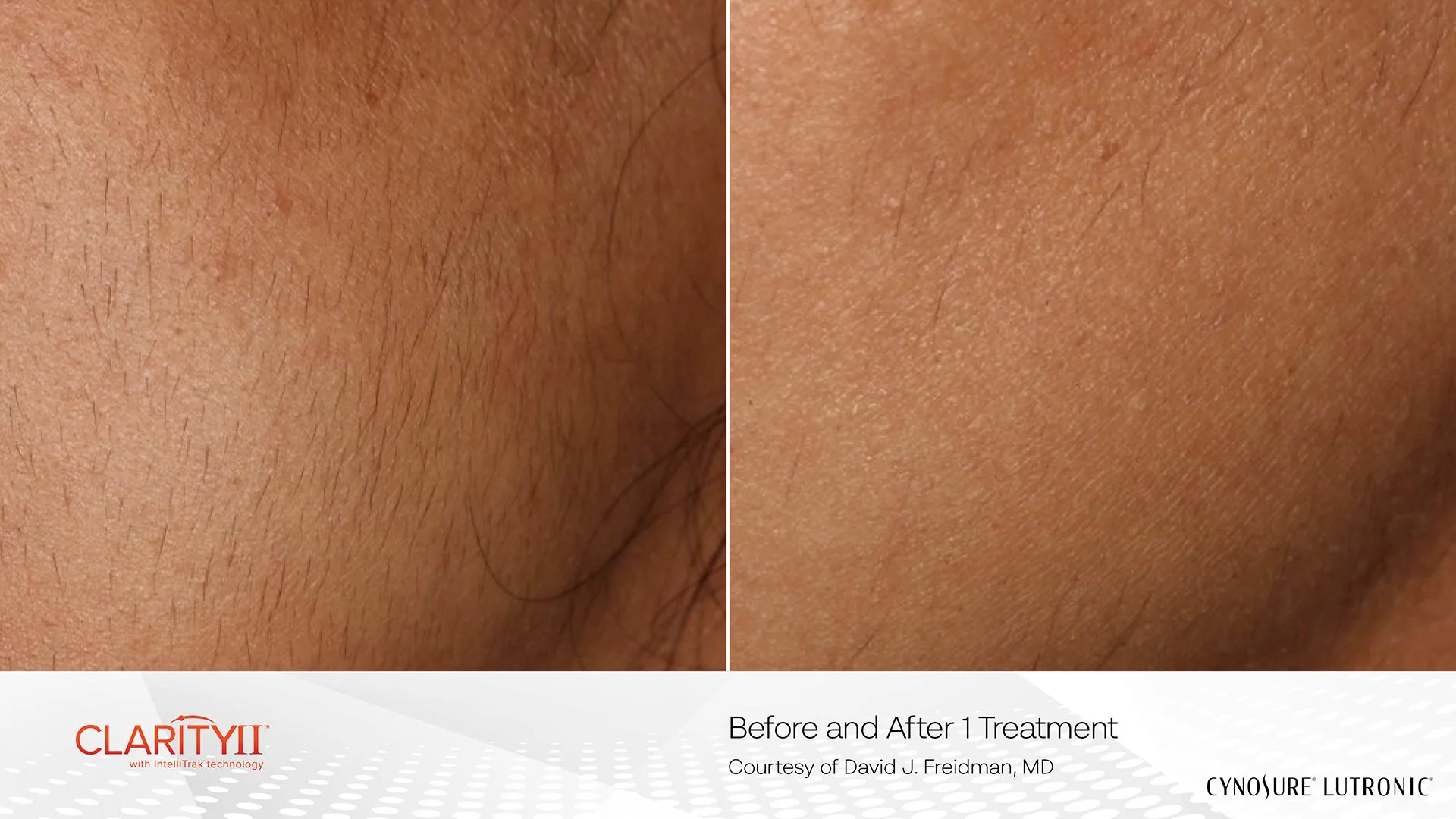 AMP-1534-Clarity-II-BNA-Cheek.jpg