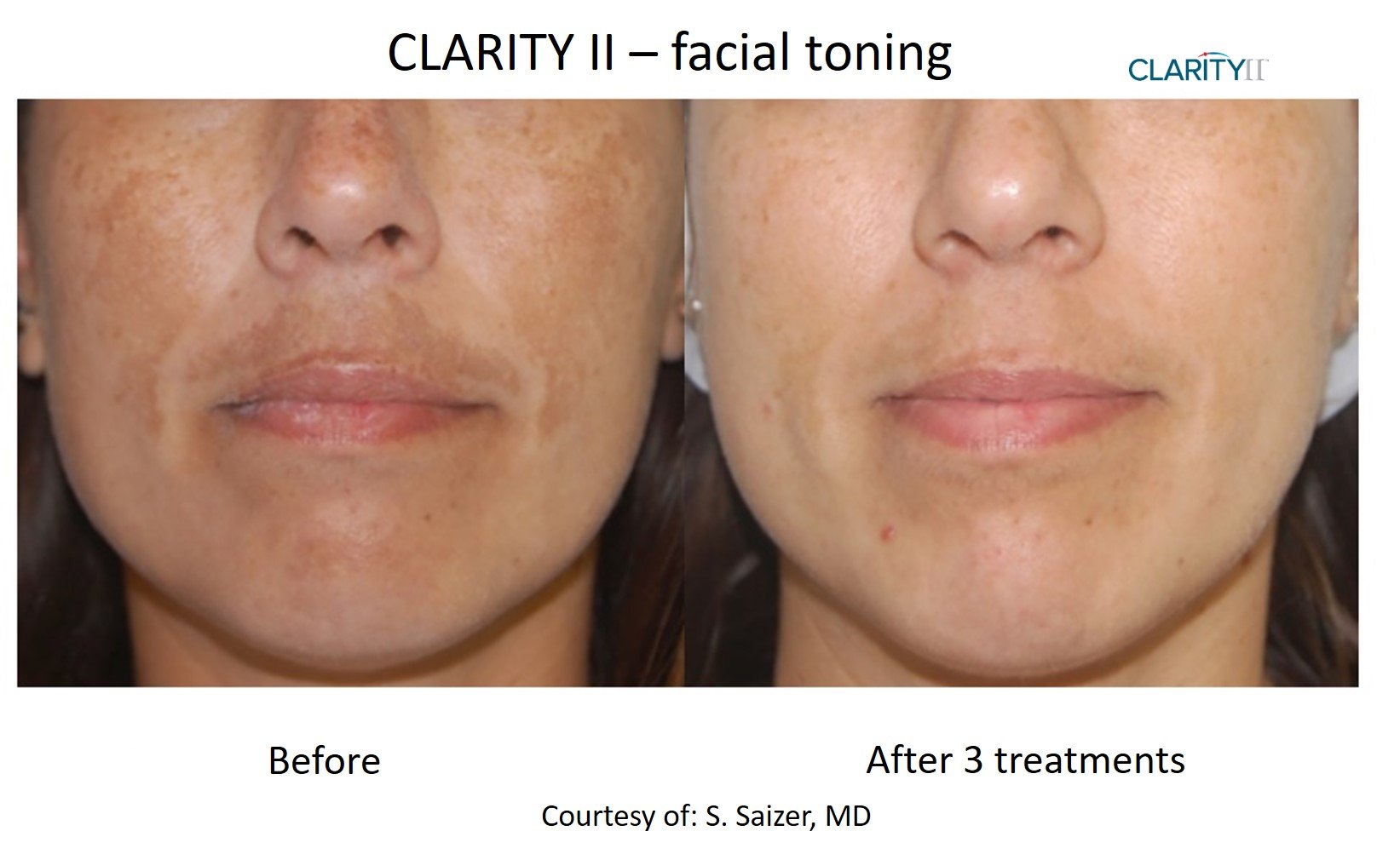Clarity II - Facial Toning 1.jpg