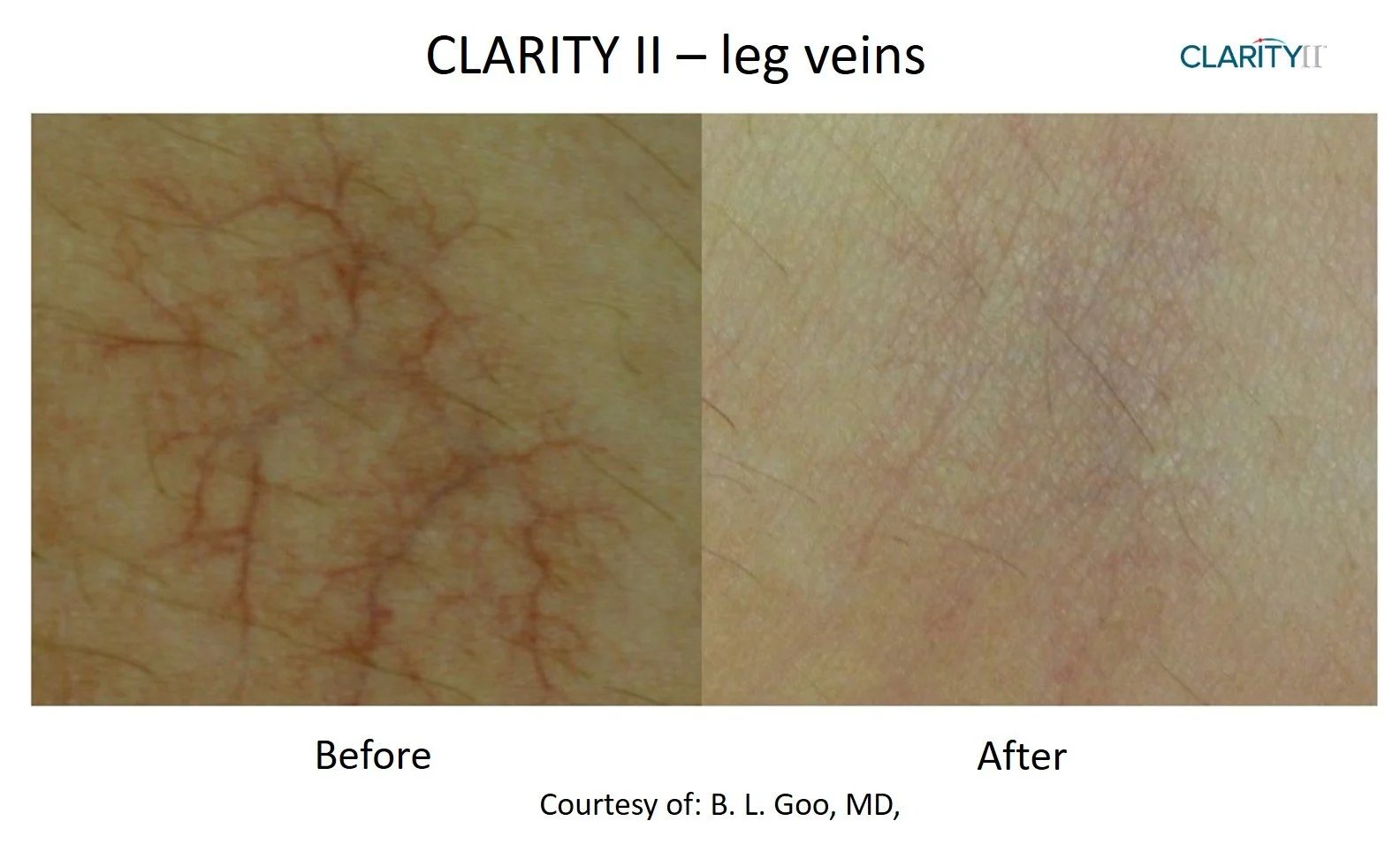 Clarity II - Vein Removal 1.jpg