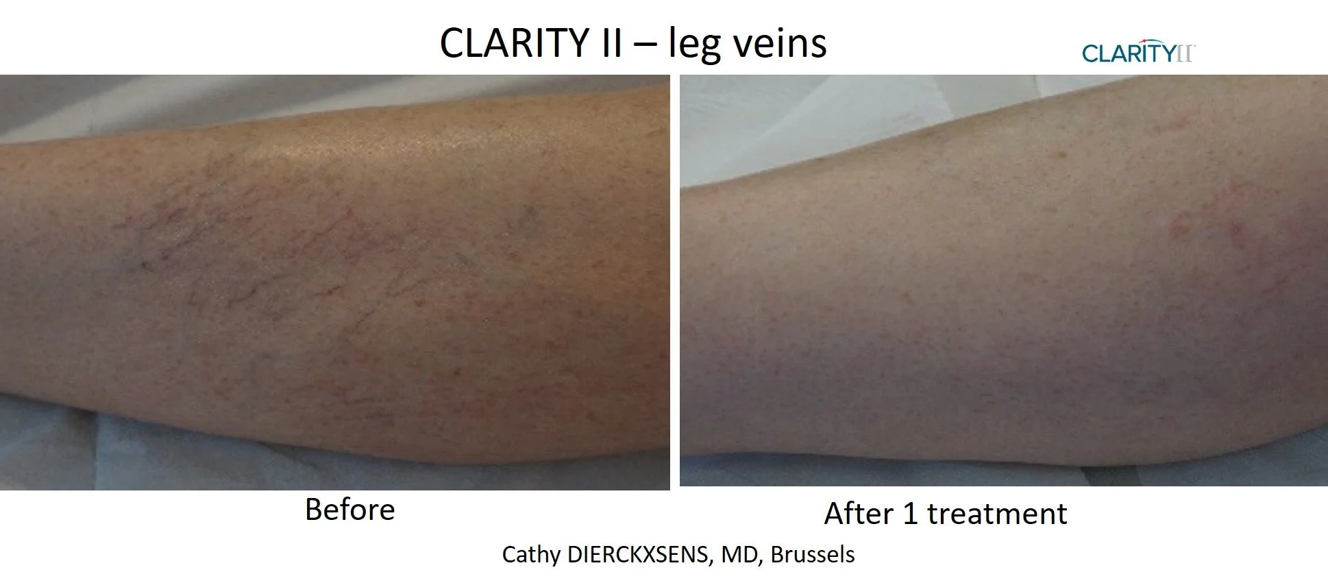 Clarity II - Vein Removal 2.jpg