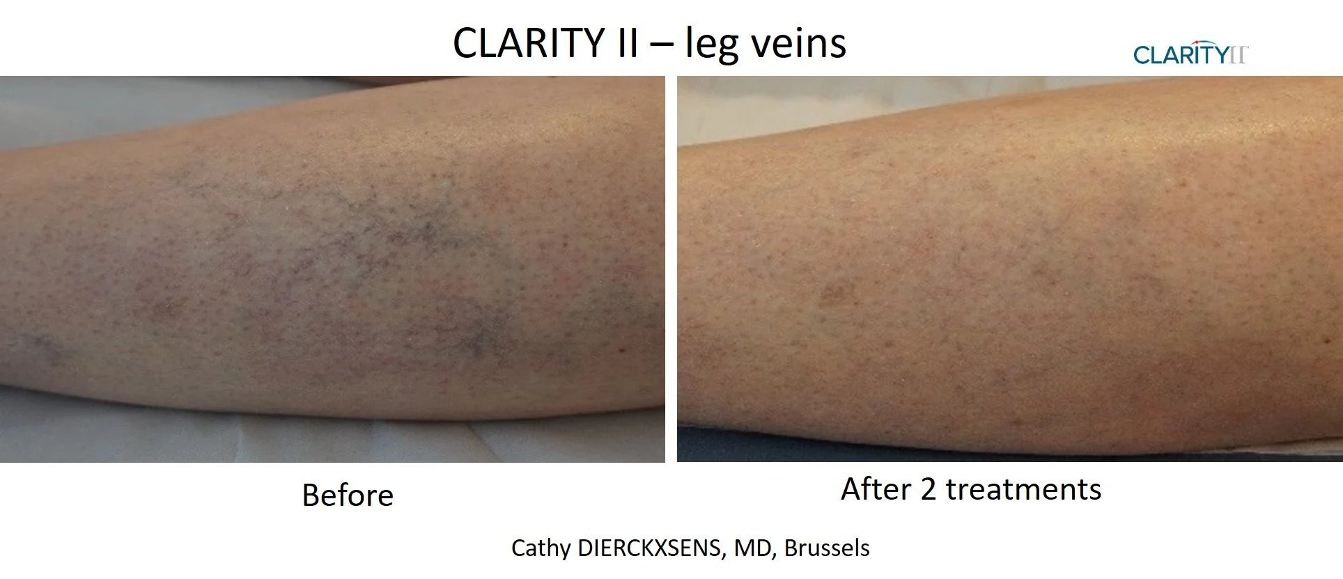 Clarity II - Vein Removal 3.jpg