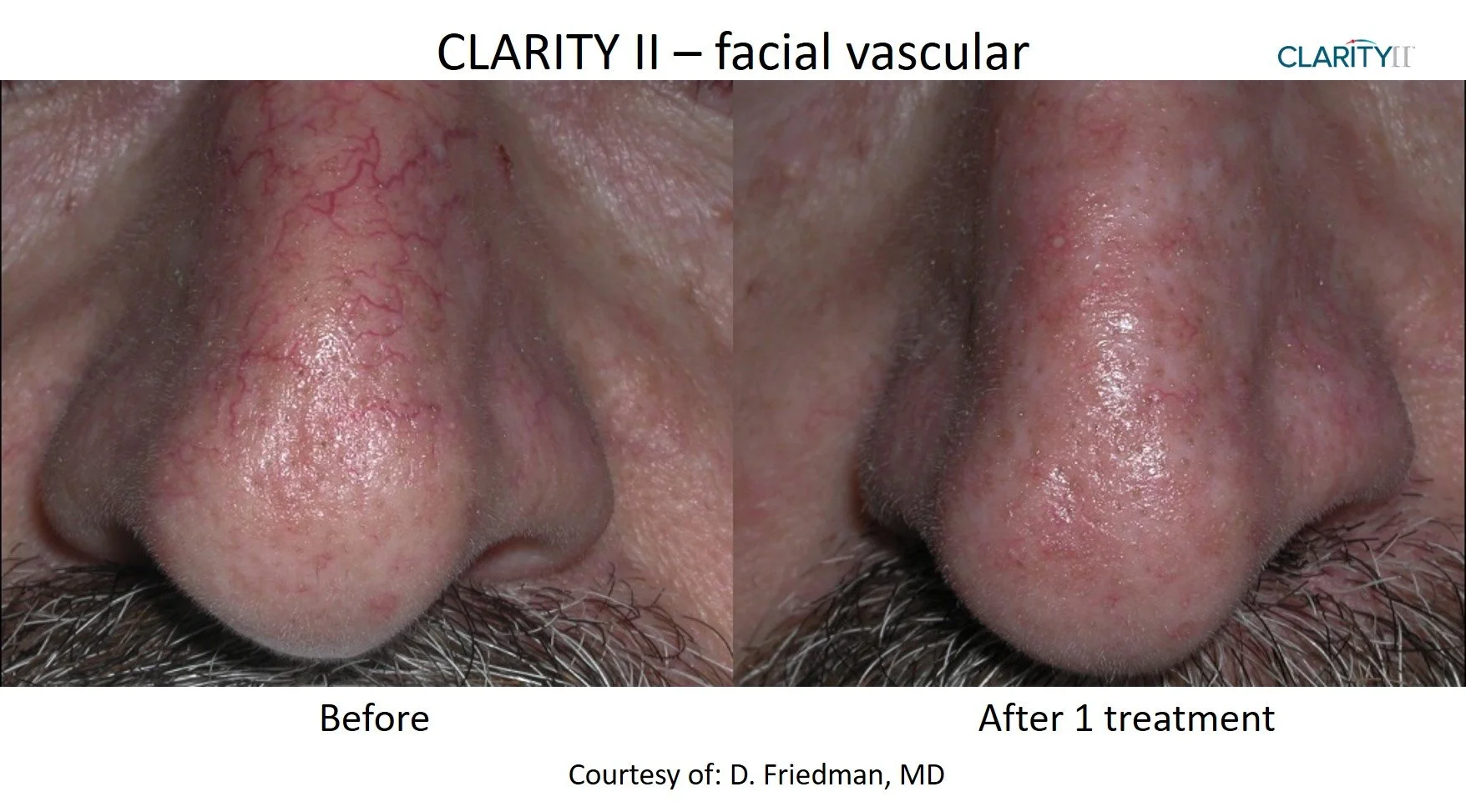 Clarity II - Vein Removal 6.jpg