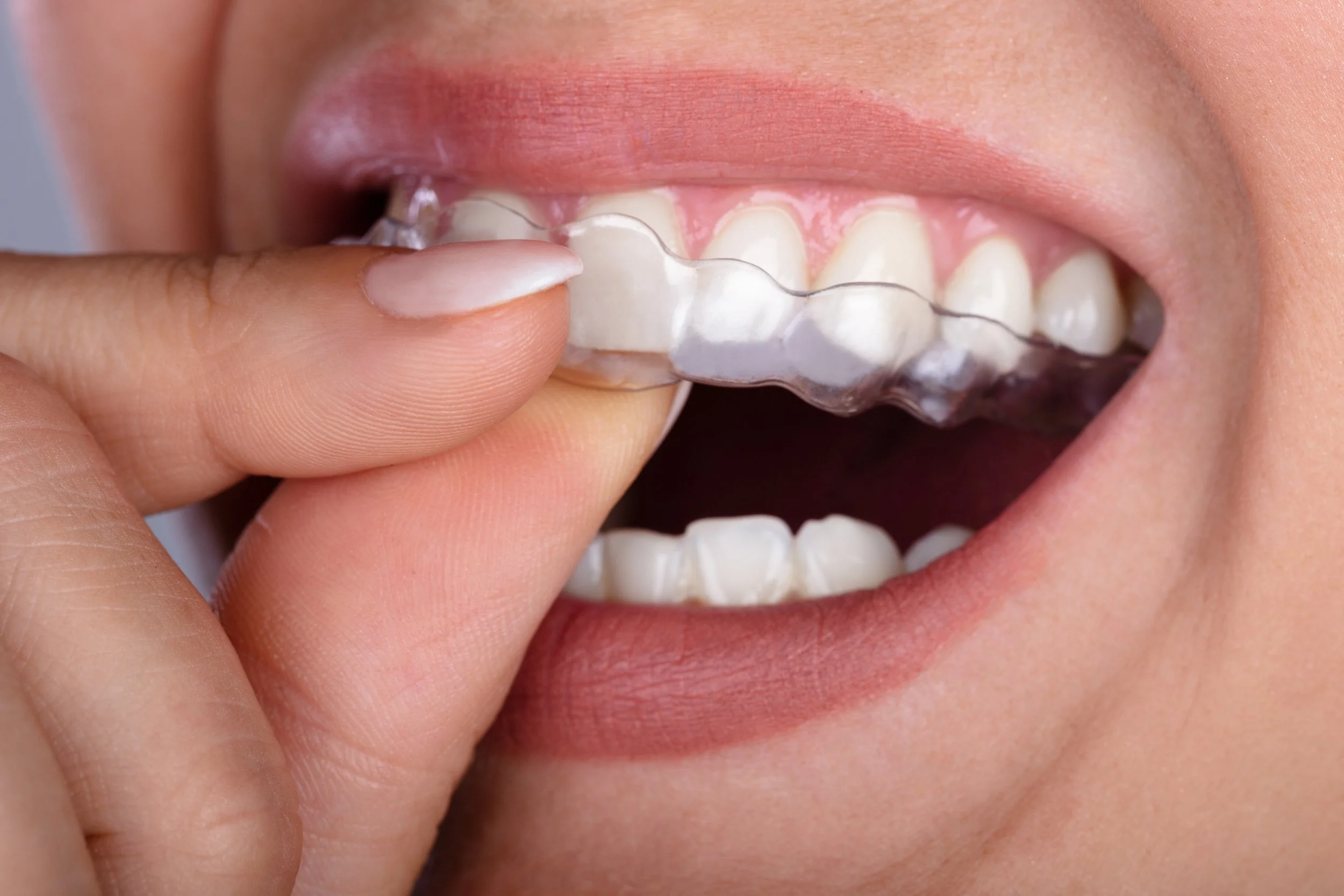 Clear Aligner Consultation
