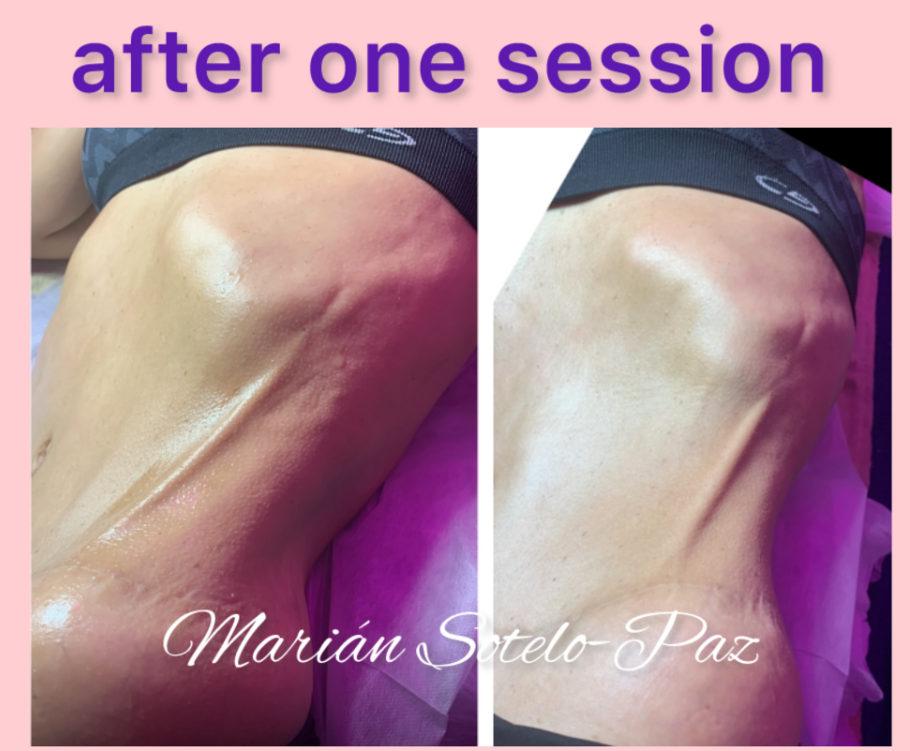 fibrosis after lipo one session result.png