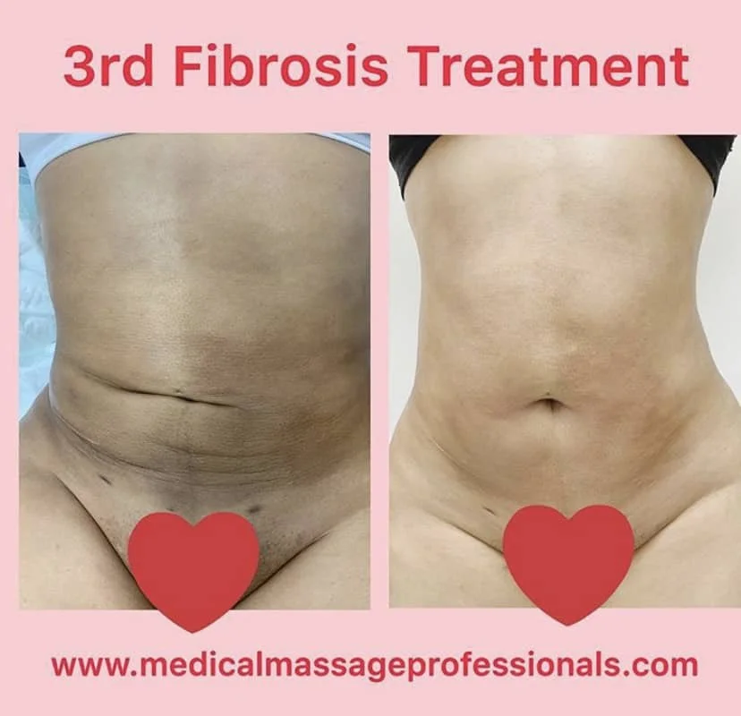 fibrosis treatment 5 session.jpg