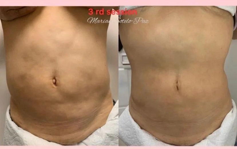 result after three sessions of fibrosis after cosmetic surgery.jpg