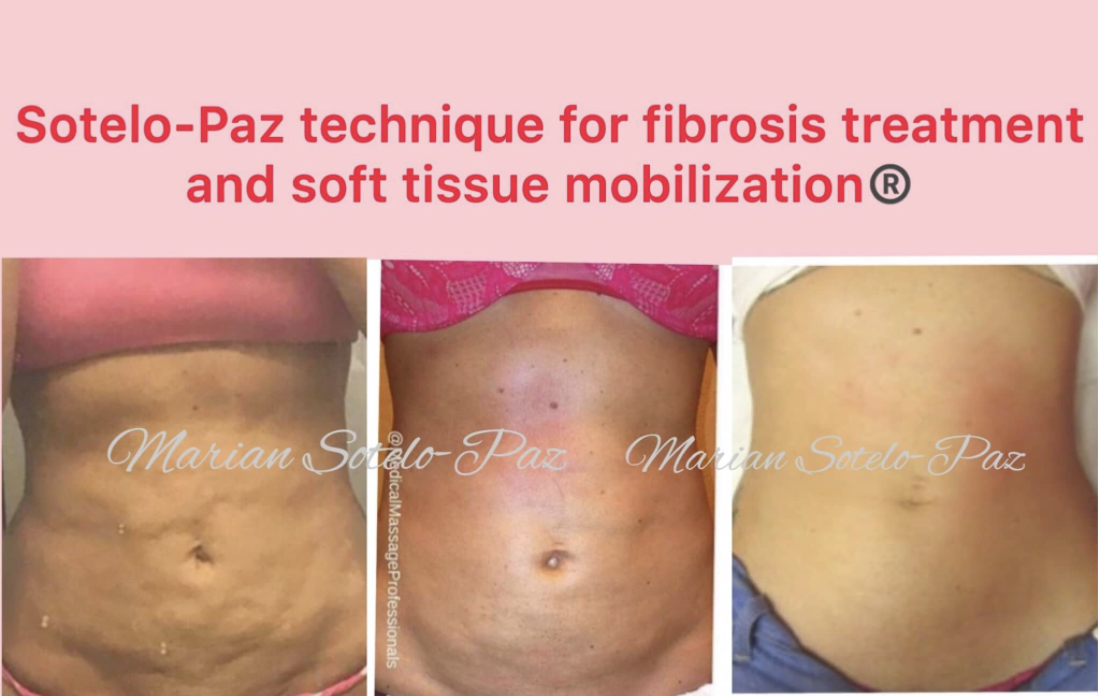 fibrosis 2016 Miami patient.png