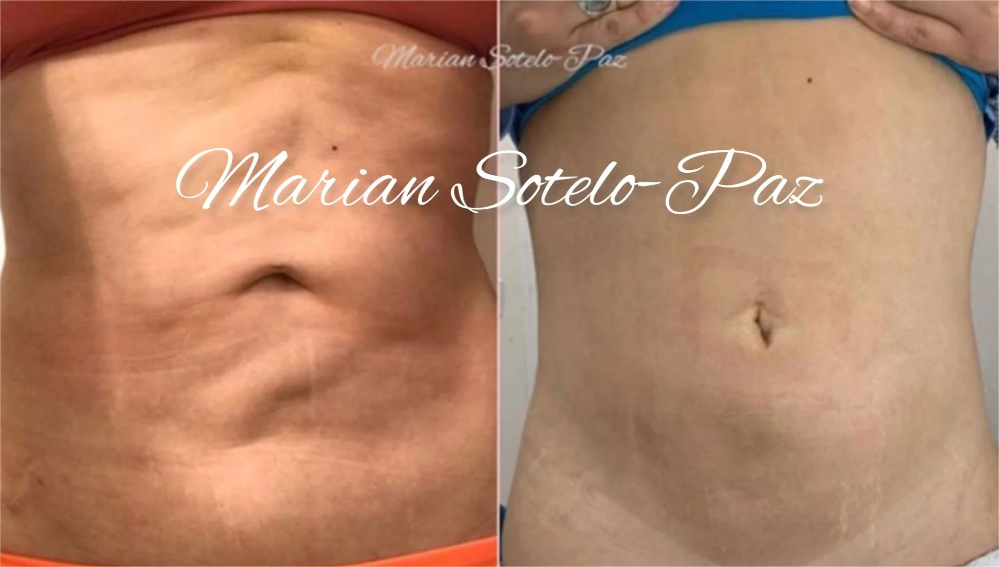 After liposuction imperfections correction