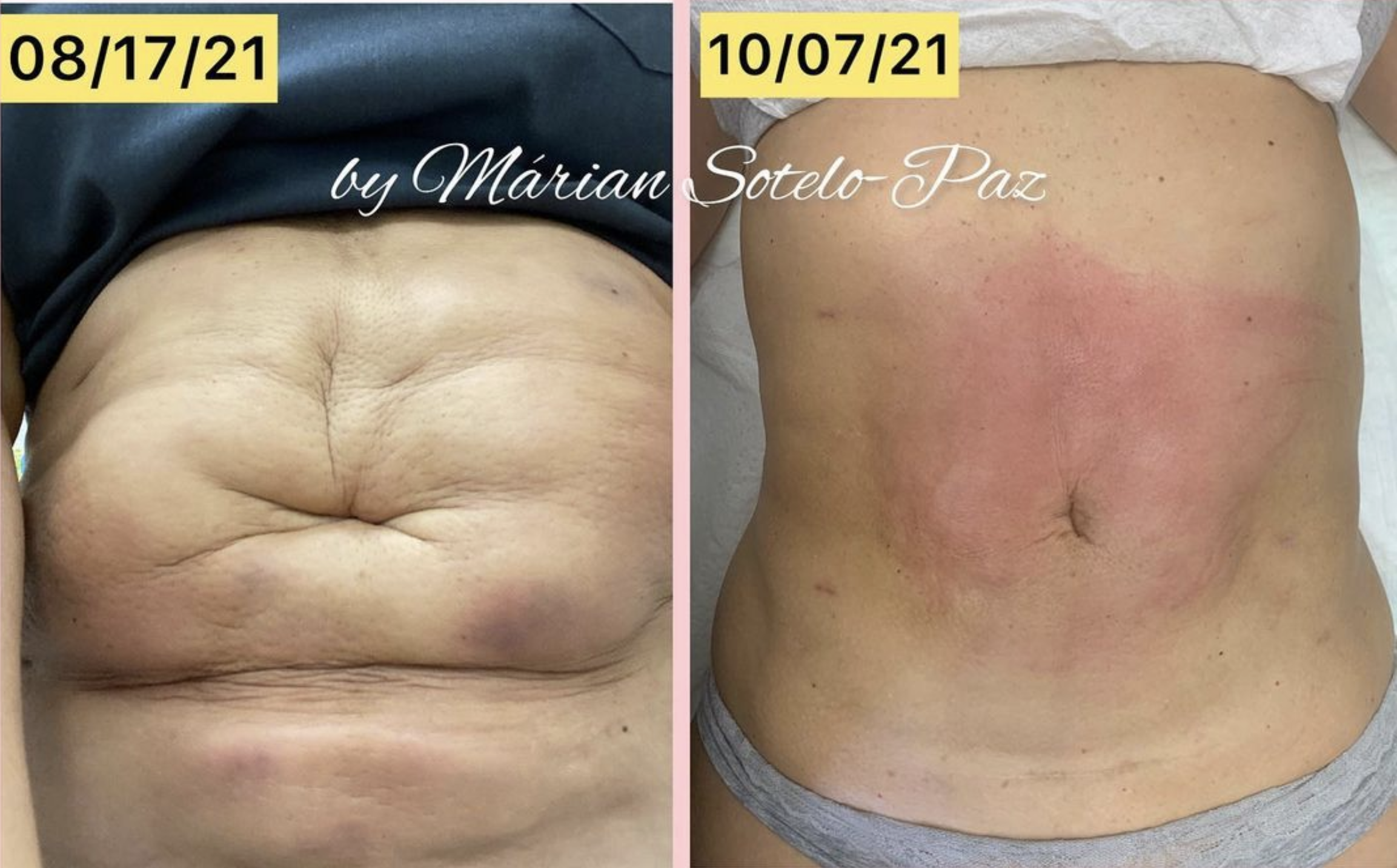 fibrosis with deformities.png