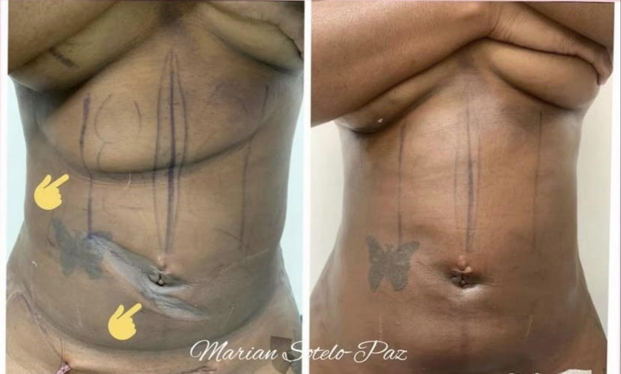 Folded skin after liposuction.png