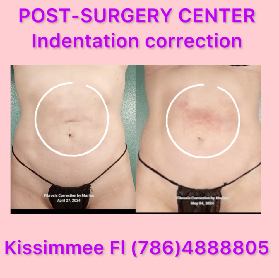 indentation-correction-after-lipo.png