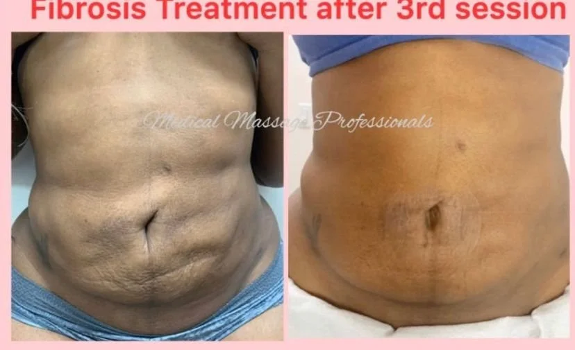 three sessions result fibrosis after liposuction.jpg